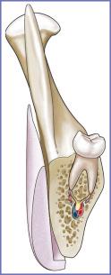 Fig. 14.4, Sagittal section of posterior mandible with off-the-shelf implant placed to augment its contour. The posterior surface of the implant does not mimic the contour of the underlying skeleton resulting in gaps between the two surfaces. Gaps result in unanticipated increase in contour.