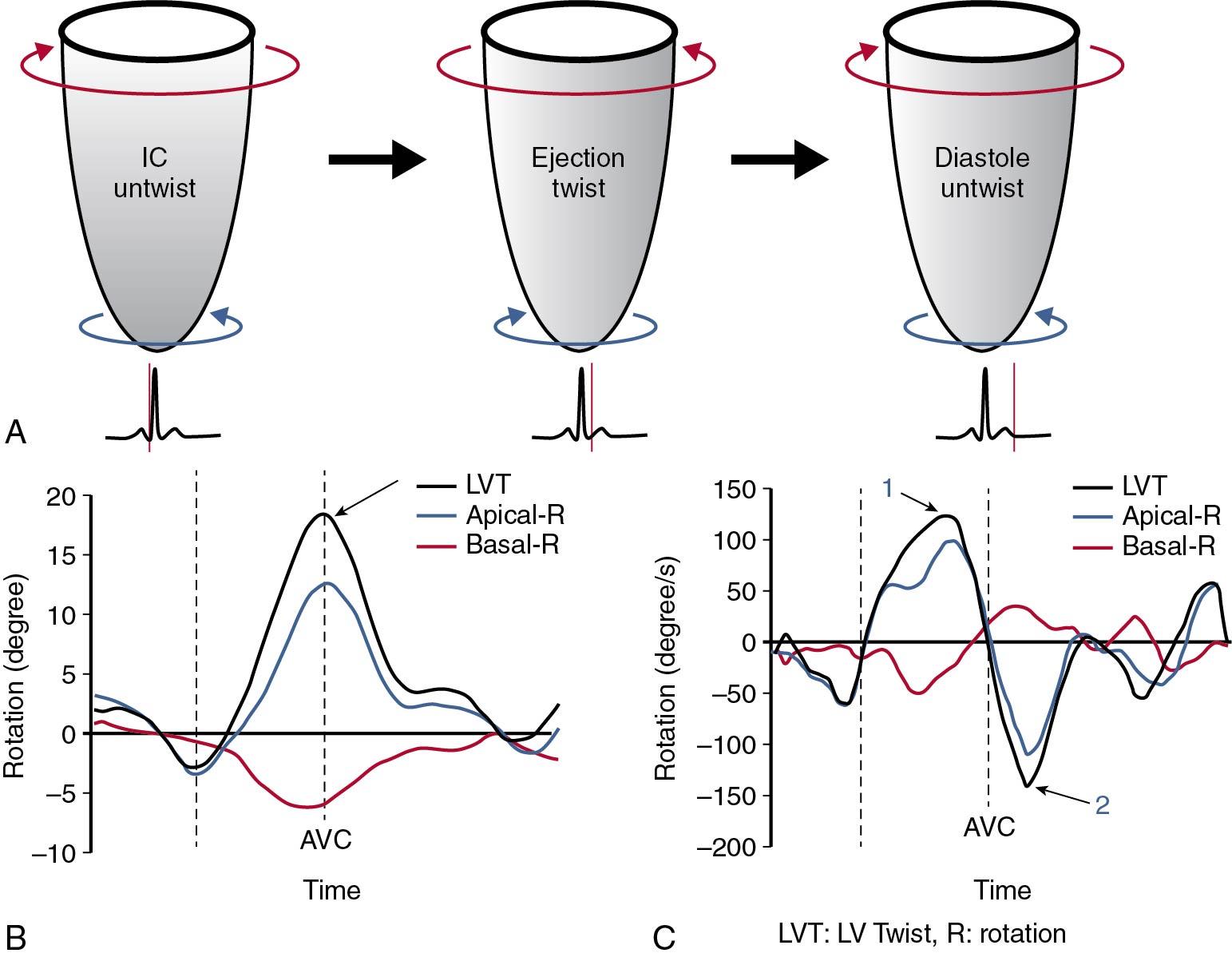 Fig. 6.10, Temporal sequence of left ventricular twist (LVT). ( A ) Relative rotation of LV base (red curved arrow) and apex (blue curved arrow) during isovolumic contraction, ejection, and isovolumic relaxation and early diastole. ( B ) LV rotational curves for the LV base (red line) and apex (blue line) from a normal healthy subject. LVT (black line and arrow) is the peak systolic difference between basal and apical rotation (arrow). ( C ) LV rotational rate curves for LV base (red line) and apex (blue line) were derived from the same healthy subject in B . LVT rate (black line, arrow 1) is measured as the peak systolic difference of basal and apical rotational rates, and LV untwist rate (black line, arrow 2) is the peak early diastolic difference between apical and basal reverse rotations.