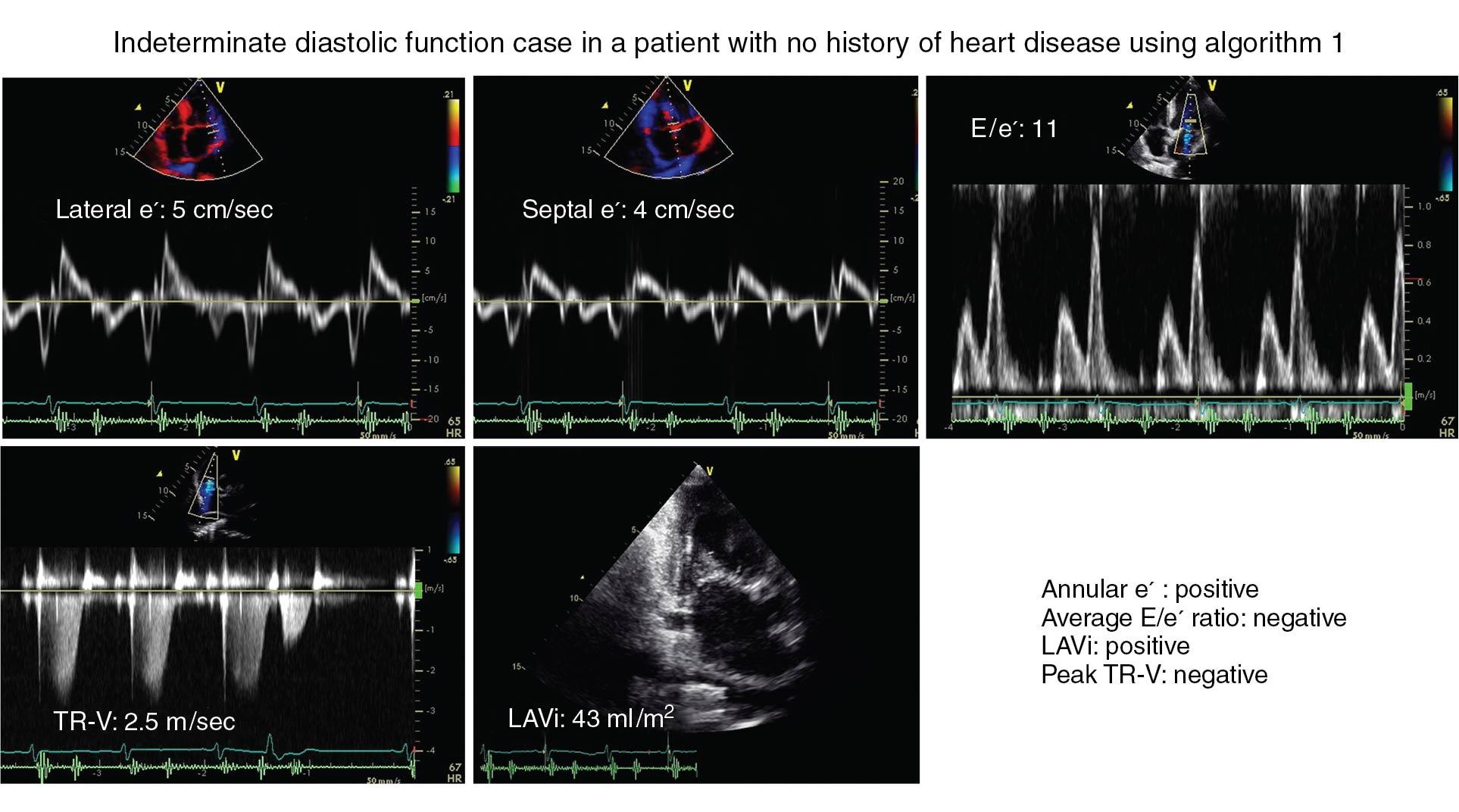 Fig. 6.3, An indeterminate case with no clinical heart disease. A 75-year-old woman with palpitations was referred to a hospital. She had no clinical heart disease. We applied algorithm 1, and there were two of four positive parameters. A presence of left ventricular (LV) diastolic function could not be determined in this case.