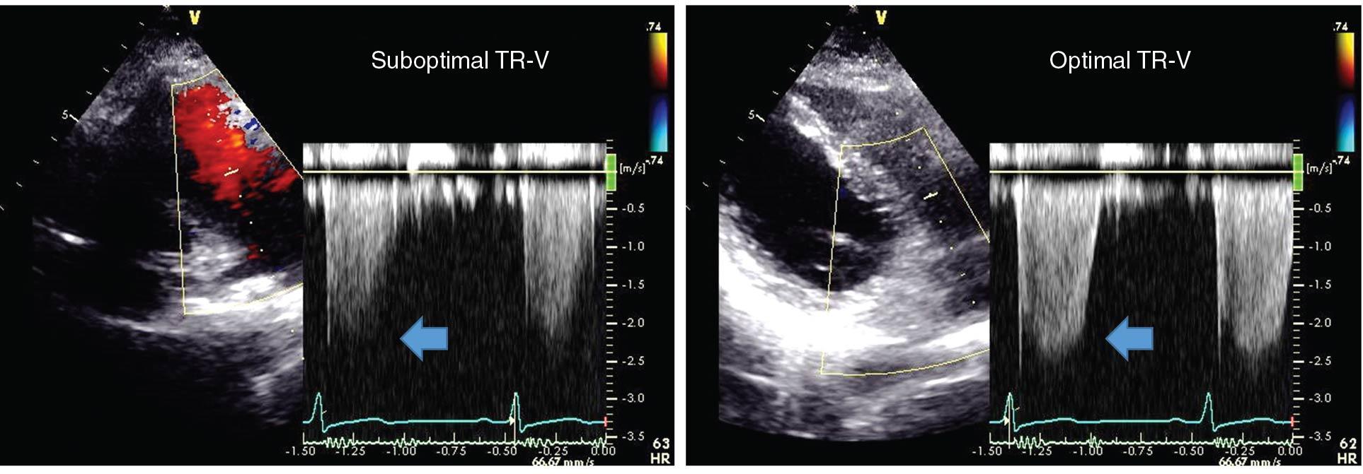 Fig. 6.4, Indeterminate assessment of diastolic function due to inadequate TR envelope. In contrast to the right panel, with a clear rounded edge of the spectral Doppler TR-V signal, the left panel shows a suboptimal TR-V due to an unclear edge.