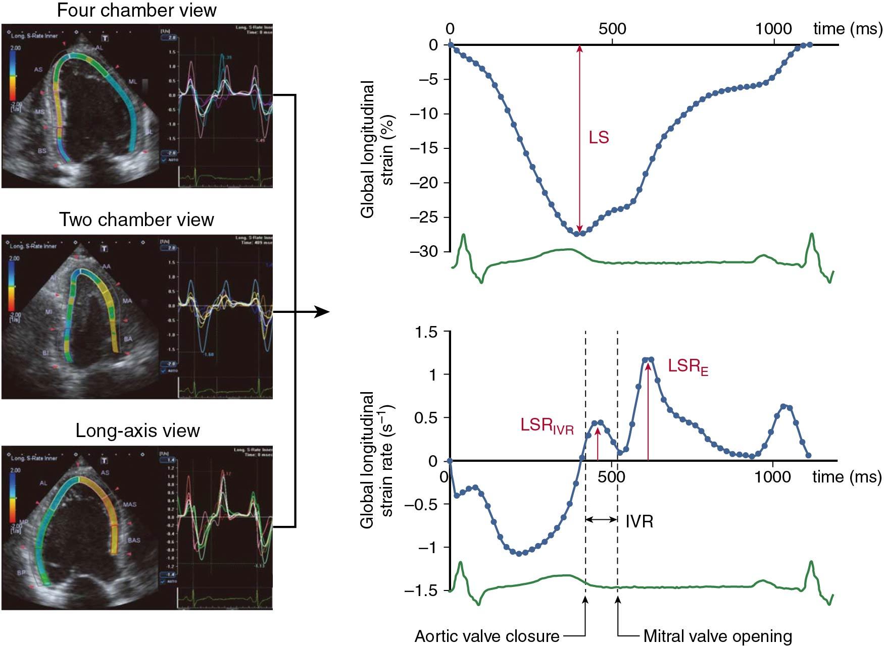 Fig. 6.6, Examples of time–global longitudinal strain and strain rate curves. The longitudinal strain and strain rate were measured in the apical four-chamber, two-chamber, and long axis views and averaged frame-by-frame to construct a time-global strain curve as well as a time-global strain rate curve. IVR, Isovolumic relaxation; LS, absolute value of peak longitudinal strain; LSRIVR, peak longitudinal strain rate during the IVR period; LSRE, peak longitudinal strain rate in the early-diastolic phase.