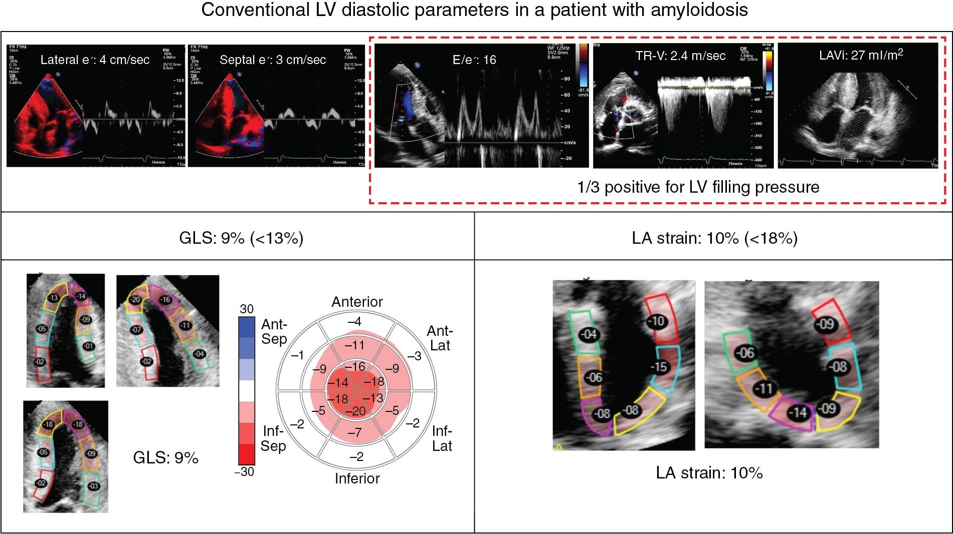 Fig. 6.9, Use of left atrial (LA) and left ventricular (LV) strains in patient with indeterminate LV filling pressure in a patient with cardiovascular disease. In this 70-year-old man with cardiac amyloidosis, diastolic recommendations provided indeterminate findings (E/e′=16, only one positive in algorithm 2). However, LV global longitudinal strain (GLS) of −9% (threshold −13%) and LARS of 10% (threshold 20%) support the presence of elevated LV filling pressure.