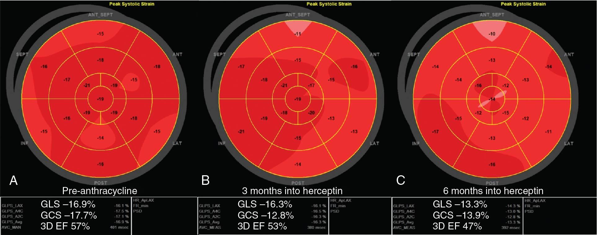 Fig. 2.5, Potential value of baseline global longitudinal strain (GLS) and global circumferential strain (GCS) in identifying patients at risk of cancer therapeutics–related cardiac dysfunction (CTRCD). This 49-year-old woman was treated with anthracyclines followed by trastuzumab. Baseline GLS and GCS were reduced at baseline, and during follow-up, the patient developed cardiotoxicity.