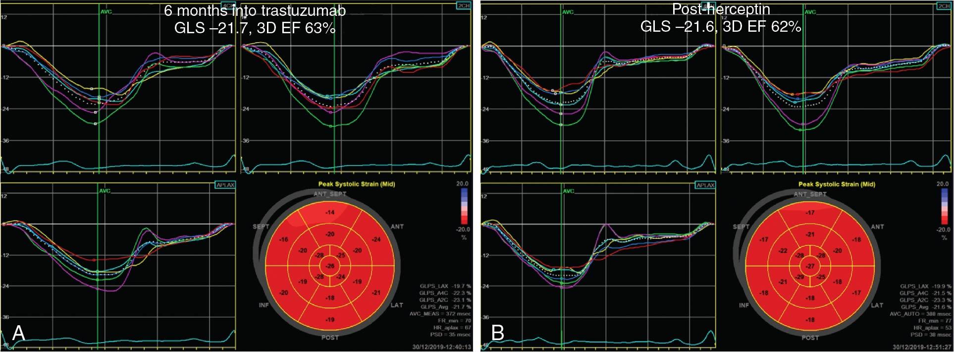 Fig. 2.6, Negative predictive valve of a normal global longitudinal strain (GLS) measurement midway through therapy when baseline values are not available. This 60-year-old woman with a history of hypertension was treated with anthracyclines followed by trastuzumab. ( A ) Baseline left ventricular ejection fraction (LVEF) was 68%, but GLS was not available; however, measures of GLS and 3D LVEF were normal at 6 months into trastuzumab therapy. This is above the absolute thresholds described in the literature associated with subsequent cardiotoxicity. ( B ) Imaging at the end of trastuzumab demonstrates preserved LVEF and GLS. This patient did not develop cancer therapeutics–related cardiac dysfunction.