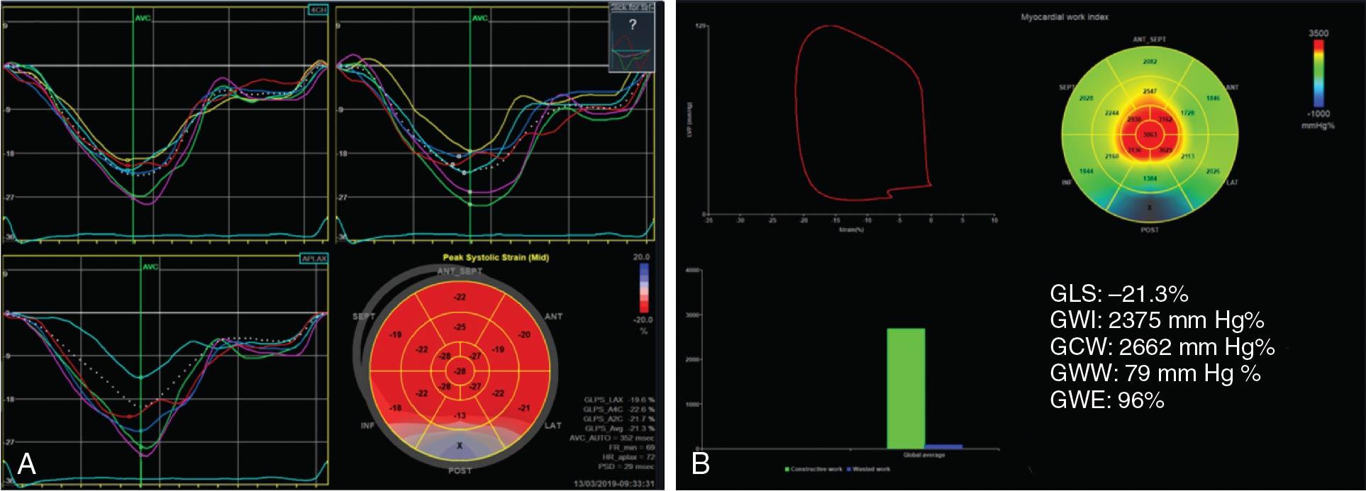 Fig. 2.8, Use of myocardial work to compensate for a change in afterload. In this 52-year-old woman receiving anthracycline therapy ( A and B ) baseline systolic blood pressure (BP) was 129/68 mm Hg, and 3D LVEF was 68%. ( A ) Baseline GLS was −21.3%, and ( B ) global work parameters, including global work index (GWI), global constructive work (GCS), global wasted work (GWW), and global work efficiency (GWE), were normal. ( C and D ) At follow-up 6 months later, there was a significant increase in systolic BP to 152/94 mm Hg. ( C ) The 3D ejection fraction was 57%, and the GLS was −19.0% (13.6% reduction). ( D ) The global work indices, particularly GWW, increased. ( E and F ) Finally, at the end of treatment the BP returned to 127/81 mm Hg, ( E ) GLS returned to baseline at −21.1%, and the 3D left ventricular ejection fraction (LVEF) was 69%. ( F ) The global work indices also returned to normal. In this patient, the reduction in GLS and 3D LVEF potentially illustrates the significant increase in BP. Because myocardial work indices account for the change in afterload, they were not affected; however, in the context of true cardiotoxicity, it would be expected that the work induced will also be reduced.