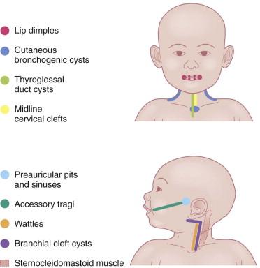 Figure 9.2, Common locations of congenital cysts, clefts, and sinuses.