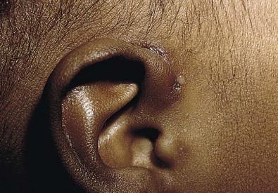 Figure 9.3, Preauricular sinus with superinfection.