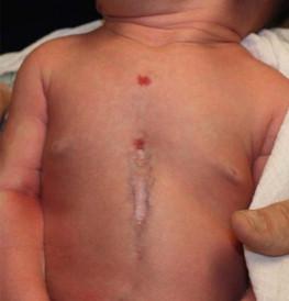 Figure 9.9, Supraumbilical raphe in an infant with PHACE syndrome.