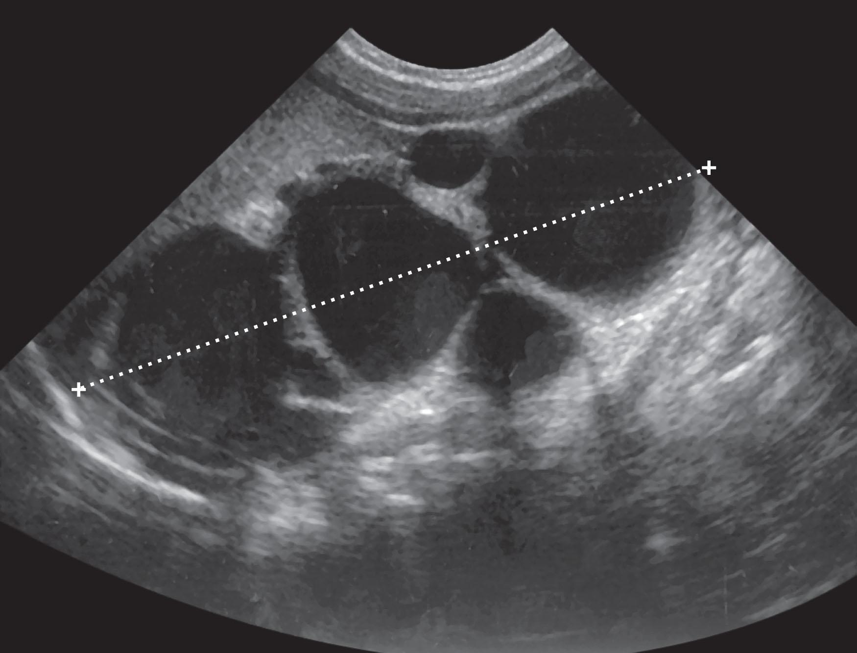 Fig. 76.2, Sonographic view of a multicystic dysplastic kidney in which multiple cysts that do not communicate with one another are grouped together, giving the typical “bunch of grapes” appearance. No function was noted on the patient’s renal scan, confirming this diagnosis.