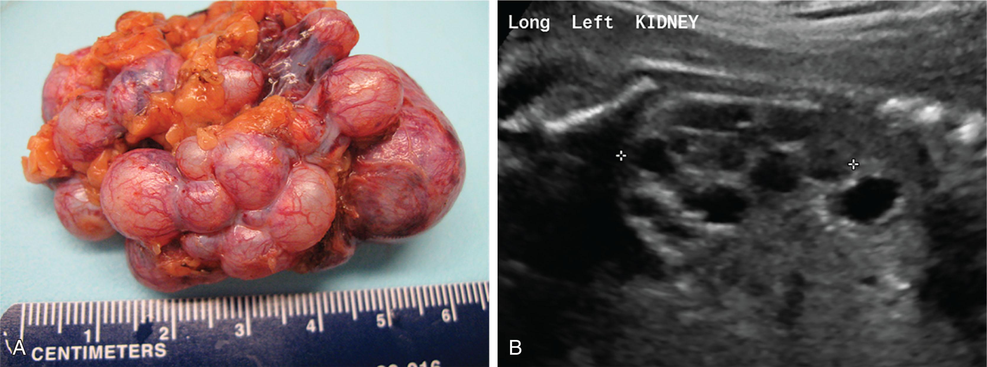 Fig. 75.2, Multicystic Dysplastic Kidney.