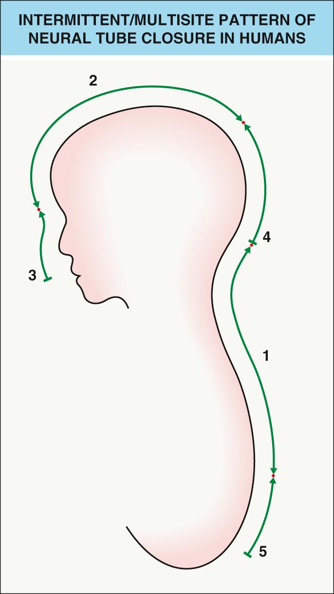 Fig. 64.1, Intermittent/multisite pattern of neural tube closure in humans.