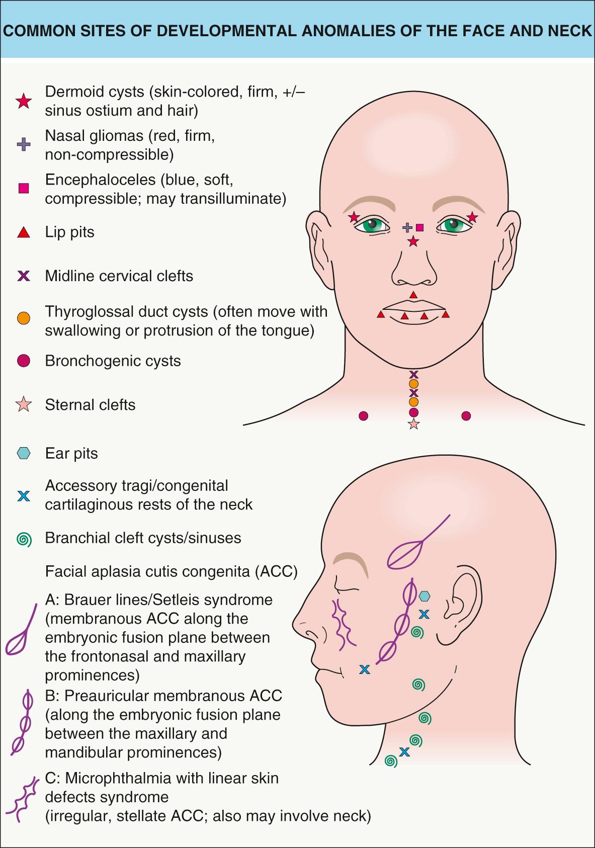 Fig. 64.2, Common sites of developmental anomalies of the face and neck.