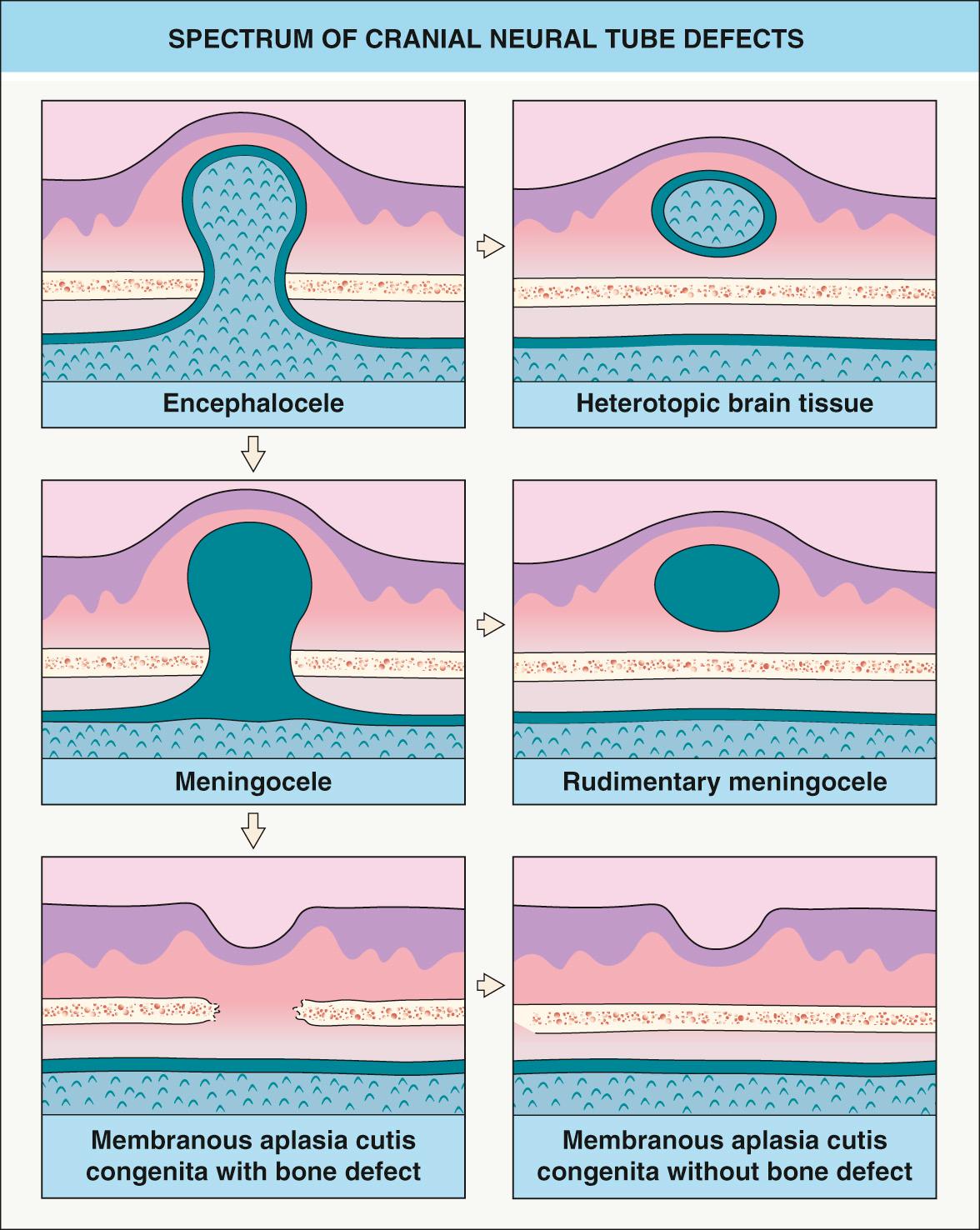 Fig. 64.8, Spectrum of cranial neural tube defects.