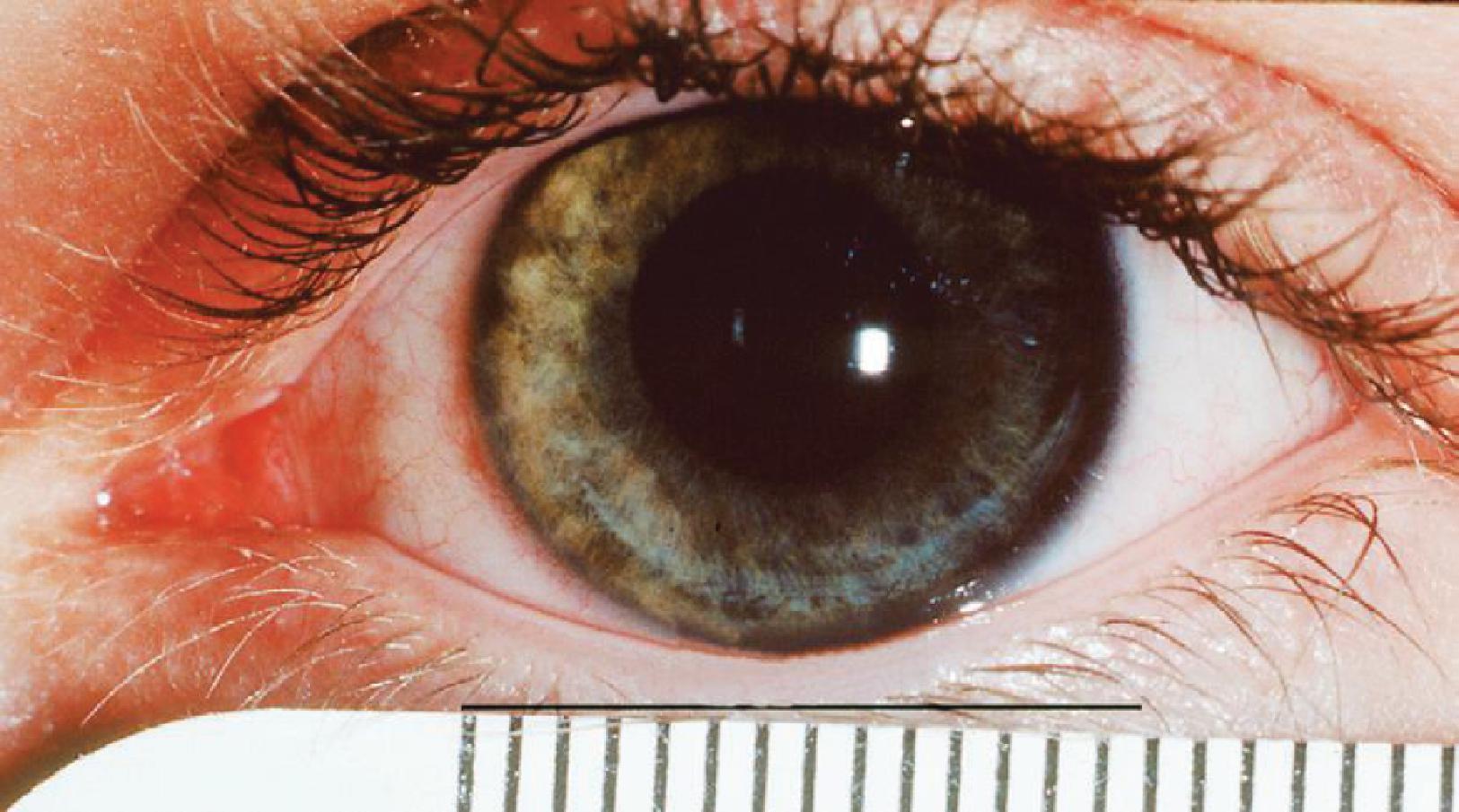 Fig. 64.5, Megalocornea .