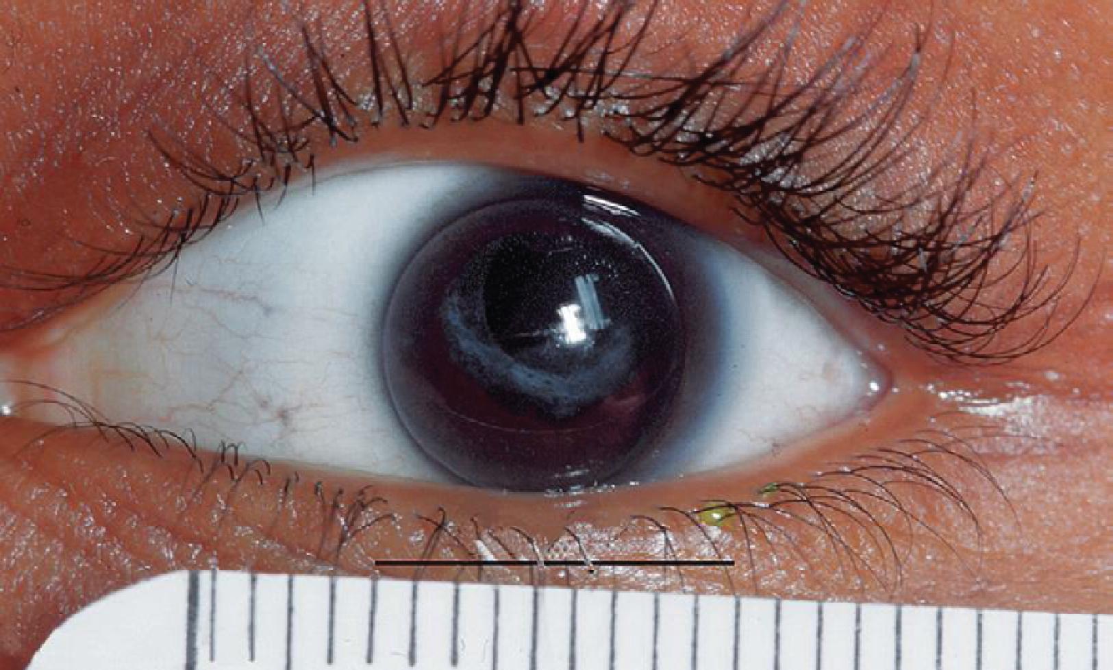 Fig. 64.6, Microcornea .