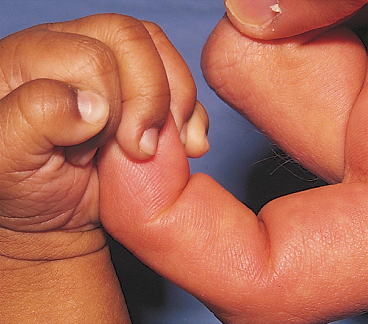 Fig. 3.12, Reflex hand grasp. A newborn reflexively grasps at a finger placed in the palm.