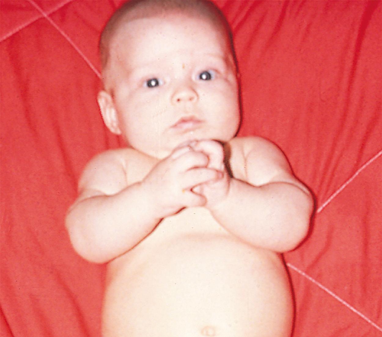 Fig. 3.13, Midline hand play. A 2-month-old infant brings the hands together at the midline.