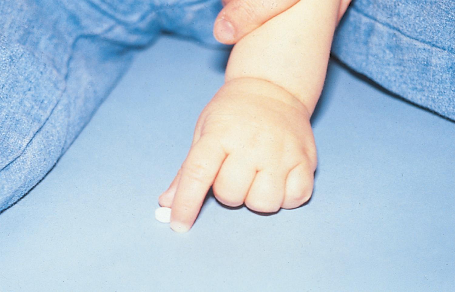 Fig. 3.17, Fine pincer grasp. A 12-month-old child lifts a pill.