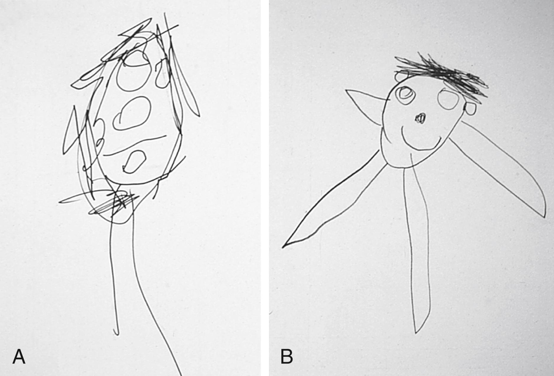 Fig. 3.20, Development of skill at drawing a person. (A) This drawing by a 4-year-old child includes five features: eyes, nose, mouth, hair, and legs. To calculate an age equivalent, the child earns 3 months for each of the five features, added to a base age of 3 years. This drawing has an age equivalent of 4 years and 3 months old. (B) A drawing by the same child at age 5 years old. Note the inclusion of ears and arms, as well as improvements in proportion. This drawing has an age equivalent of 4 years and 9 months old.