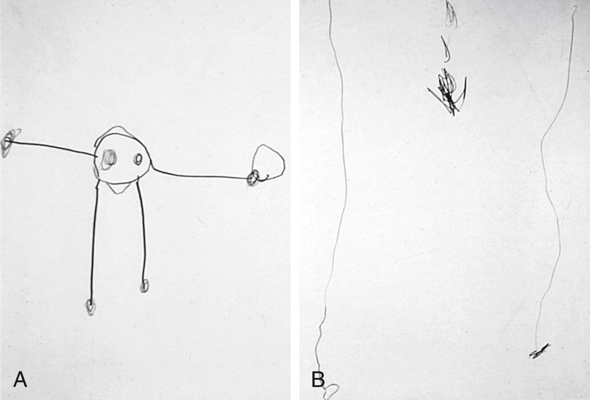 Fig. 3.21, Difficulties with visual/fine motor integration skills in a child with cerebral palsy. (A) Drawing by a bright 4 year old who was born prematurely but showed no developmental delays. Note the inclusion of seven features: eyes, hair, mouth, arms, hands, legs, and feet. The age equivalent for this drawing is 4¾ years old. (B) Drawing by a 4-year-old child with spastic diplegia. Difficulties in organization appear related to visual motor integration skills rather than to problems with fine motor skills.
