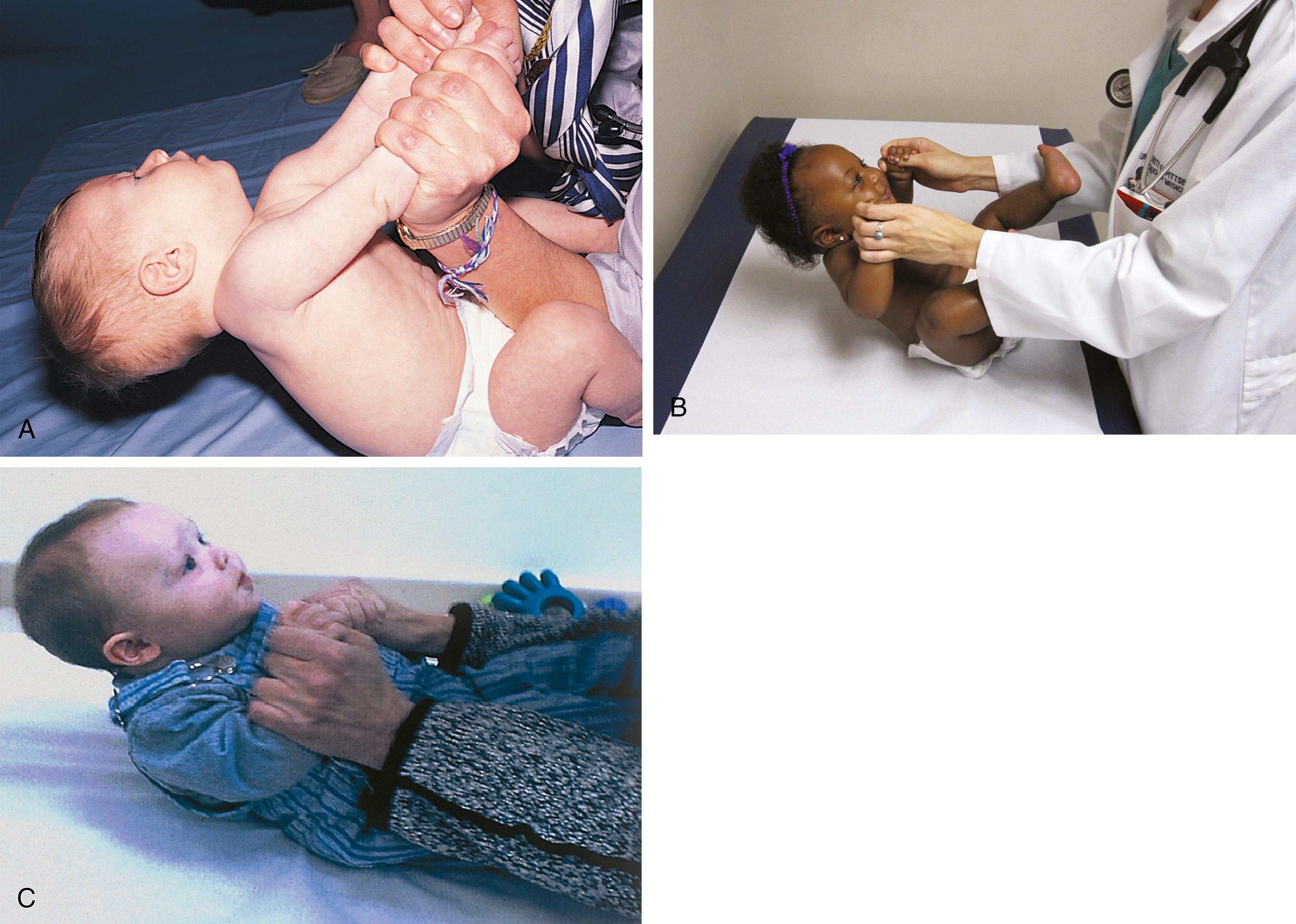 Fig. 3.4, Development of head control on the pull-to-sit maneuver. (A) At 1 month old, the head lags after the shoulders. (B) By 4 months old, the child is able to support the head, and the head moves along with the shoulders. (C) At 5 to 6 months old, the child anticipates the movement and raises the head before the shoulders.