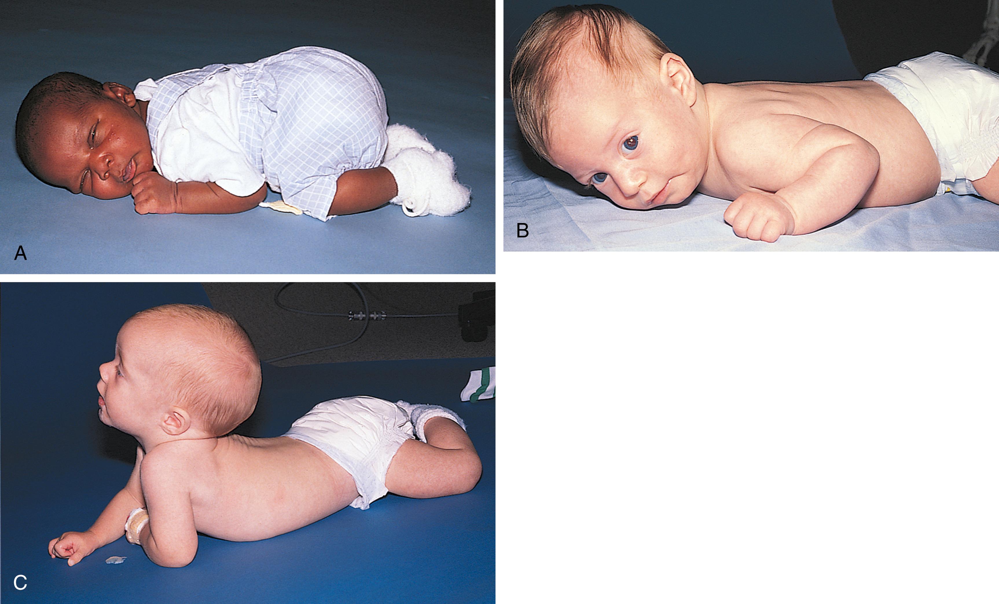 Fig. 3.5, Development of posture in the prone position. (A) The newborn lies tightly flexed with the pelvis high and the knees under the abdomen. (B) At 2 months old, the infant extends the hips and pulls the shoulders up slightly. (C) At 3 to 4 months old, the infant keeps the pelvis flat and lifts the head and shoulders.