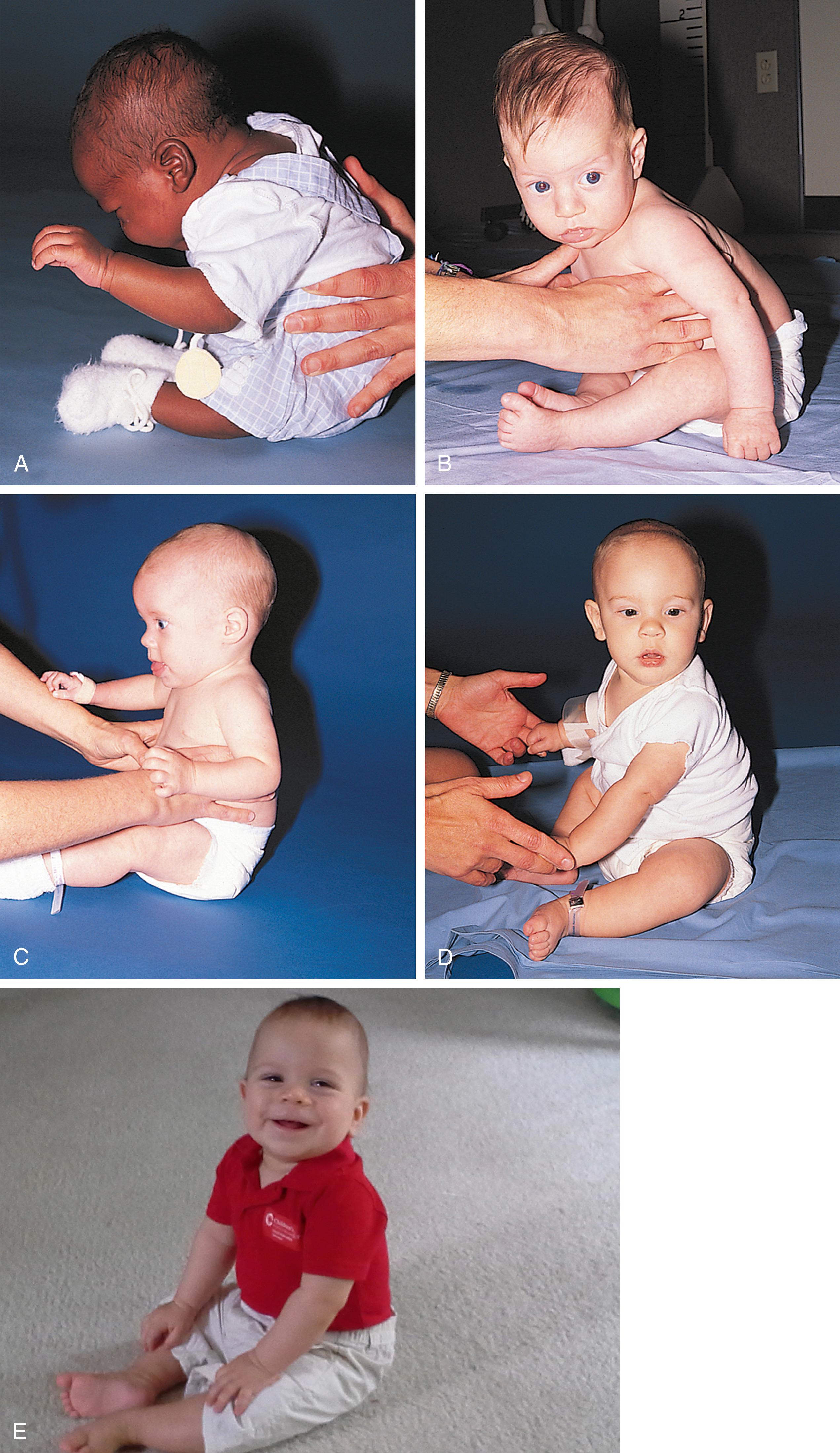 Fig. 3.6, Development of sitting posture. (A) At 1 to 2 months old, the head is held up intermittently, but trunk control is lacking. (B) At 2 to 3 months old, the infant raises the head and shoulders well but lacks control of the thoracolumbar area. (C) At 3 to 4 months old, support in the lumbar area is required to sit. (D) At 5 to 6 months old, the infant holds the head erect and the spine straight. (E) Between 7 and 9 months old, the infant can sit without support.