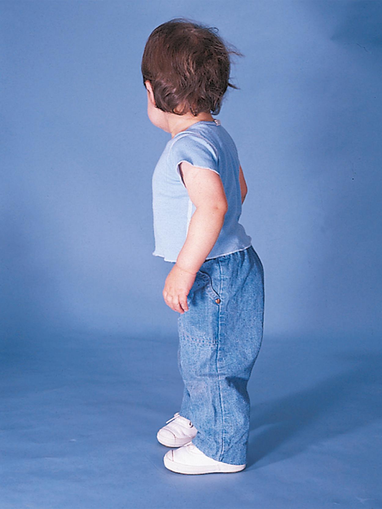 Fig. 3.7, Standing. By 1 year old, the lordotic curve, exaggerated here by a diaper, is evident.