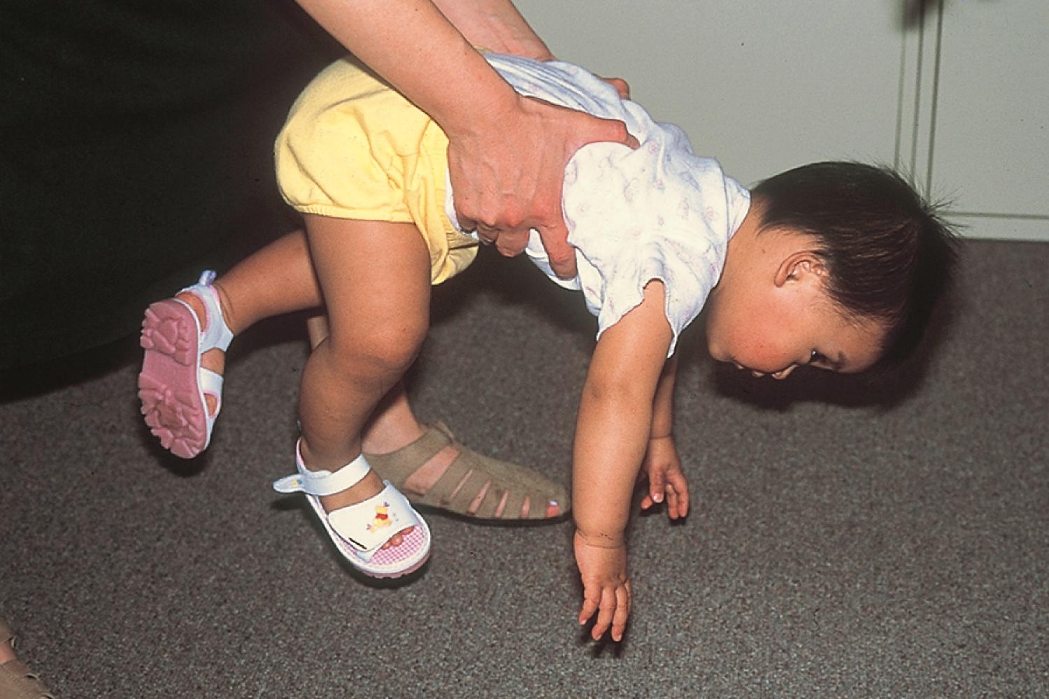 Fig. 3.9, Parachute response. As the examiner allows the child to free fall in ventral suspension, the child’s extremities extend symmetrically to distribute his weight over a broader and more stable base on landing.