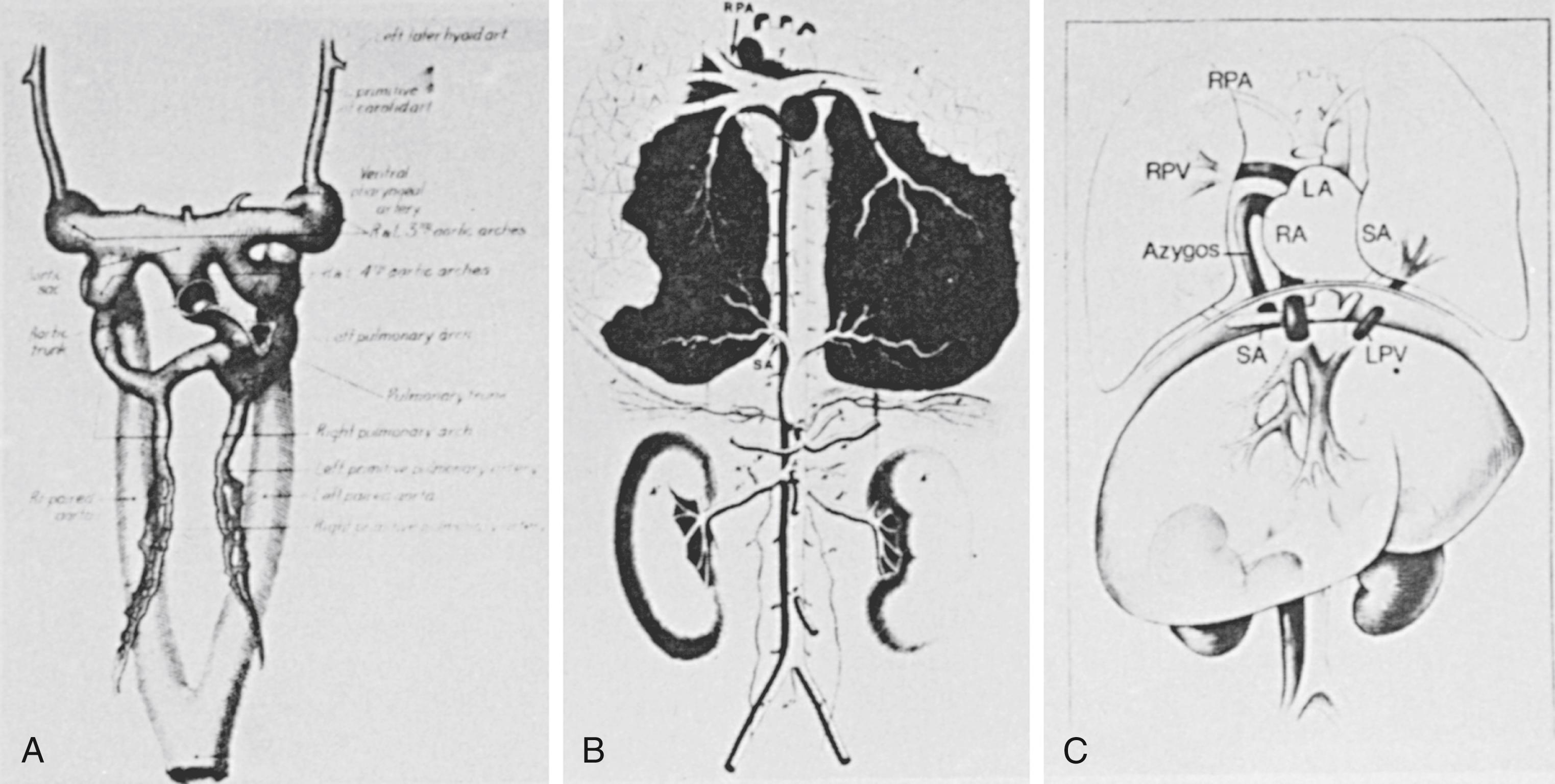 Fig. 47.1, (A) Early embryologic development shows normal disparity between the large main pulmonary artery and narrow right and left branch pulmonary arteries at 5 weeks. (B) Only the arterial system is shown. The bilateral systemic arteries arising from a single trunk supply the lower lobes. (C) An infant with persistent pulmonary hypertension and developmental arrest at 5 weeks gestation. LA, Left atrium; LPV, left pulmonary vein; RA, right atrium; RPA, right pulmonary artery; RPV, right pulmonary vein; SA, systemic arteries.