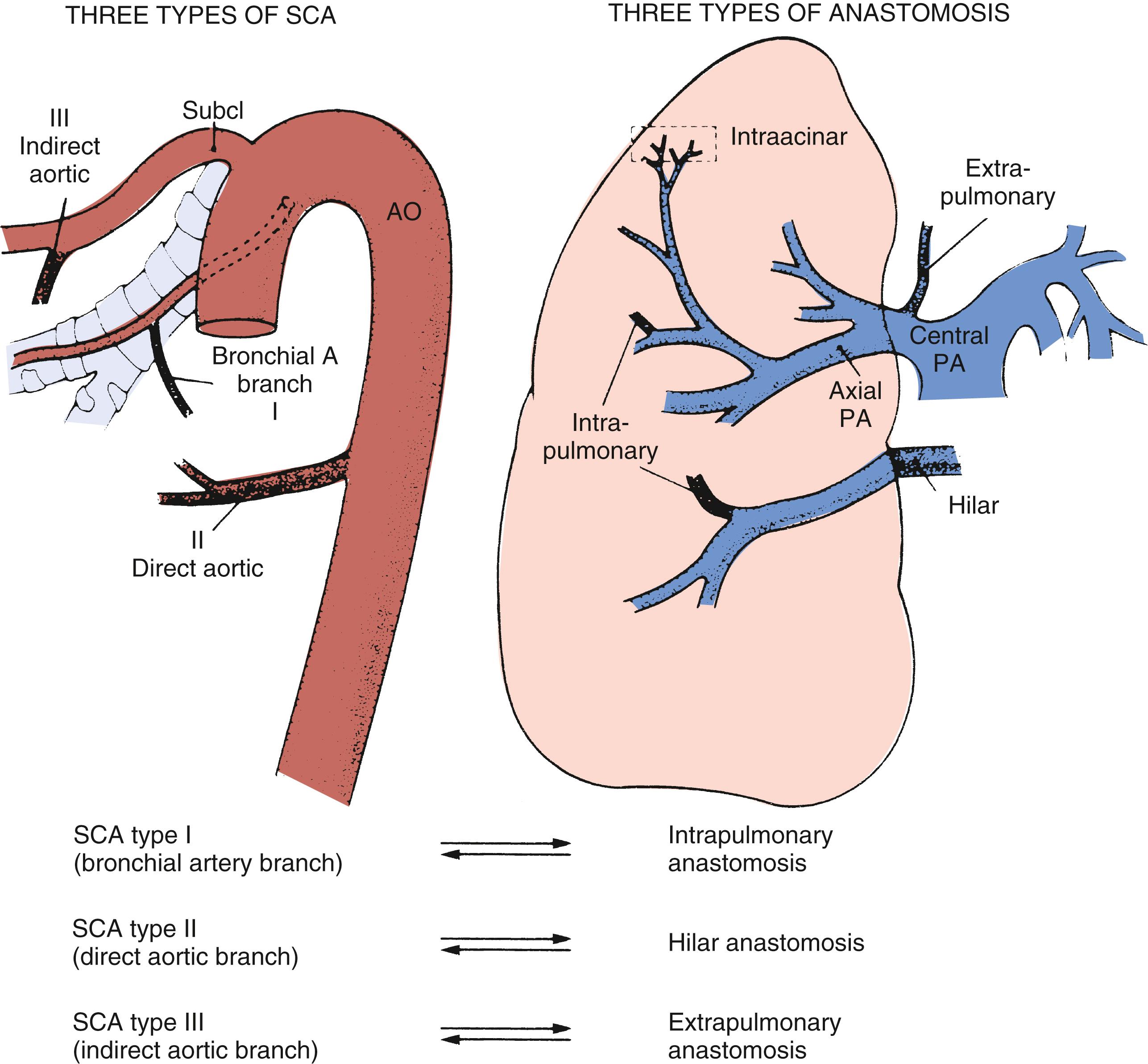 Fig. 47.2, The three types of systemic collateral artery (SCA) and the three types of anastomosis with the pulmonary artery (PA) . The characteristic pattern of anastomosis for each type of SCA is given. AO, Aorta; Subcl, subclavian.