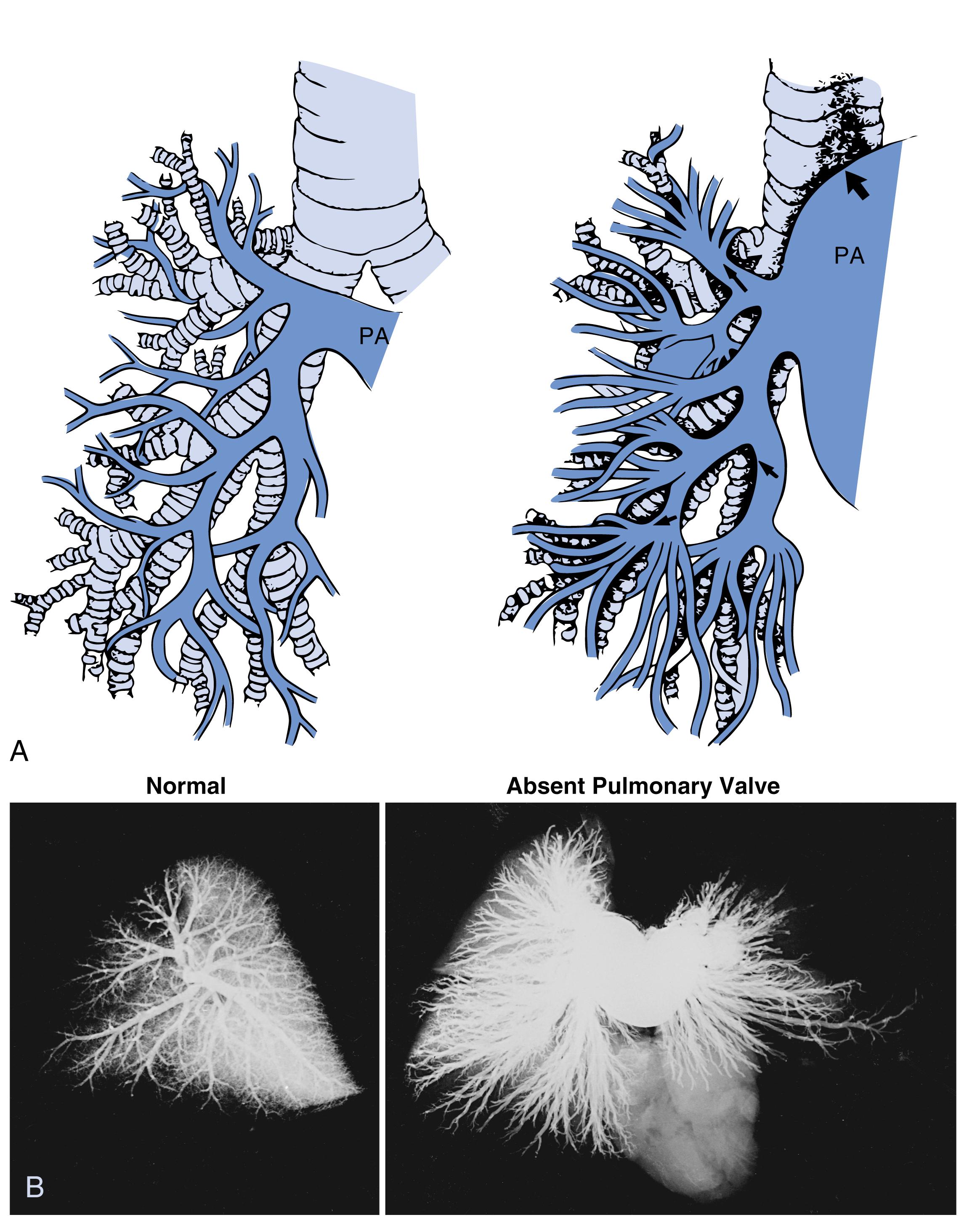 Fig. 47.3, (A) Diagrammatic representation of normal pulmonary artery (PA) branching and the abnormal pattern seen in cases of absent pulmonary valve syndrome—tufts of vessels emerging at the segmental artery level that entwine the bronchi. Arrows denote large right pulmonary artery compressing right mainstem bronchus. (B) Postmortem arteriograms from a 4-day-old normal infant (left) following severe cardiorespiratory failure and from a 4-day-old patient with absent pulmonary valve syndrome associated with a ventricular septal defect and d -transposition of the great arteries (right), showing tufts of vessels in both lungs.