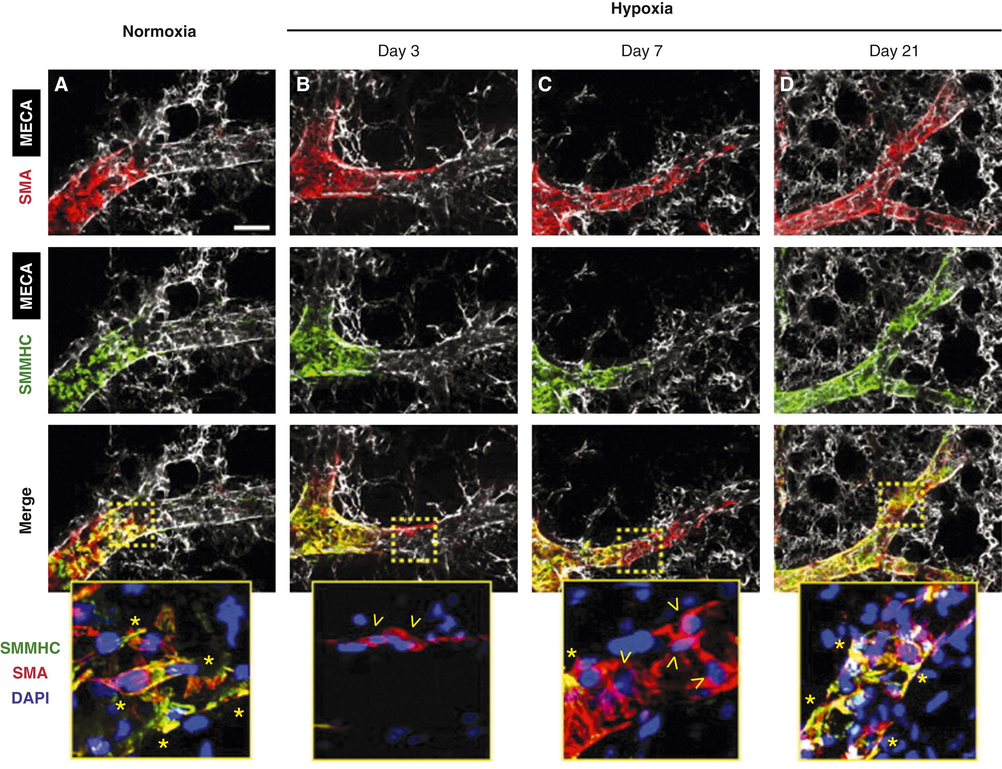 Fig. 47.4, Dynamic and distinct expression of smooth muscle actin (SMA) and smooth muscle myosin heavy chain (SMMHC) during hypoxia-induced distal pulmonary arteriole muscularization. (A–D) Adult mice were exposed to normoxia or to hypoxia for 3, 7, and 21 days as indicated, and then left lungs were stained for SMA (red) , SMMHC (green) , MECA-32 (white) , and nuclei (DAPI, blue ). Representative confocal images of arteriole beds located in proximity to L.L1.A1 airway branches. The boxed regions in the merged images are shown as close-ups below with asterisks and open arrowheads representing SMA + SMMHC + and SMA + cells, respectively. Note the transitory down-regulation of SMMHC in SMA + cells in the distal arteriole at 3 and 7 days of hypoxia. Scale bar, 25 μm.