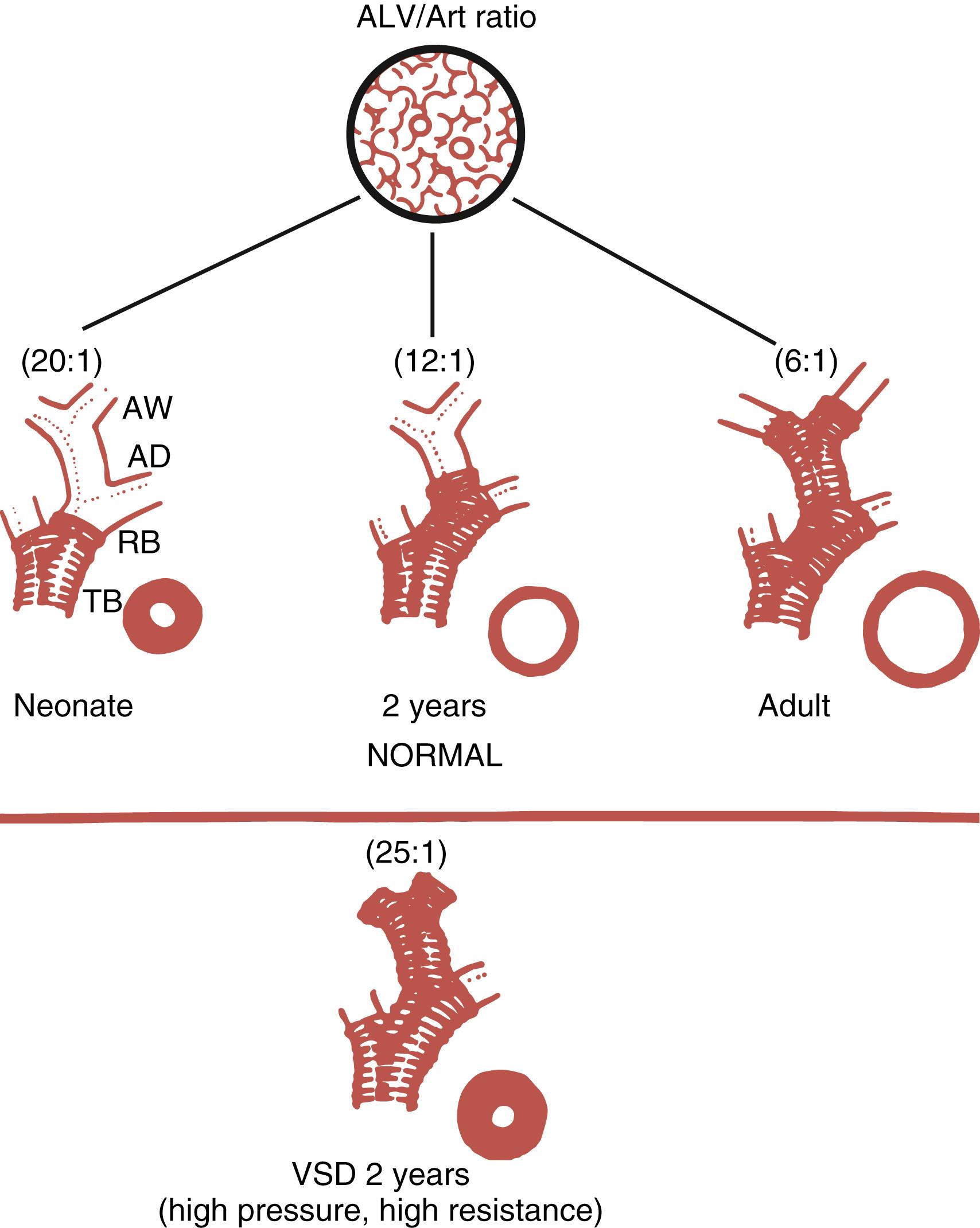 Fig. 47.5, Schema showing peripheral pulmonary arterial development through morphometric changes: extension of muscle into peripheral arteries, percent wall thickness, and artery number (alveolar-arterial ratio), as they relate to age. Top panel , Normal development. Bottom panel , Abnormalities in all three features in a 2-year-old child with a hypertensive ventricular septal defect (VSD) . AD, Artery accompanying an alveolar duct; ALV/Art, alveolar-arterial; AW, artery accompanying an alveolar wall; RB, artery accompanying a respiratory bronchiole; TB, artery accompanying a terminal bronchiole.