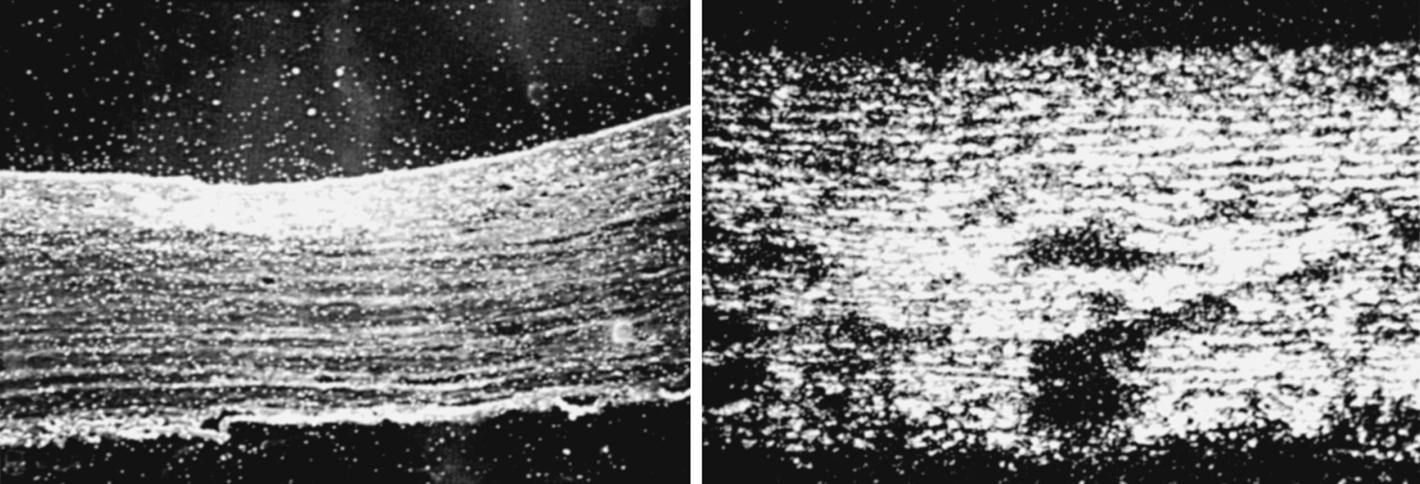 Fig. 47.7, In situ hybridization localization of tropoelastin messenger RNA (mRNA) in control and hypertensive vessels from neonatal calves. White staining over areas indicates tropoelastin mRNA labeling. In normotensive vessels (left), labeled cells ( 35 S-labeled T66-T7) were confined to the inner media. Minimal signal is noted in the outer vessel wall. In vessels from hypertensive animals (14 days of hypoxia) (right), intense autoradiographic signal was observed throughout the media, albeit in a patchy distribution.