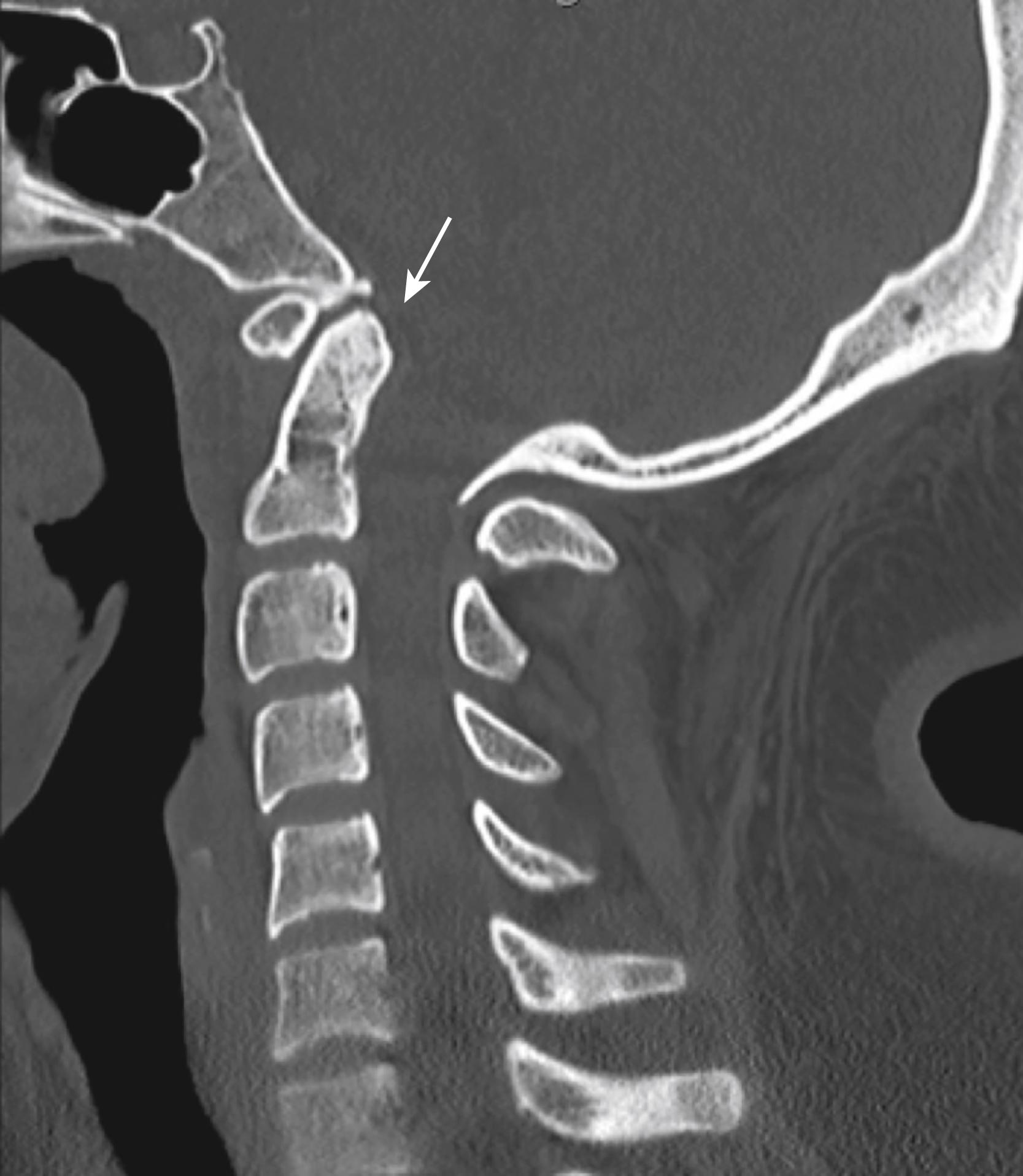 Fig. 25.2, Basilar invagination in a 17-year-old girl. Note upward migration of the dens well into the foramen magnum ( see white arrow ).