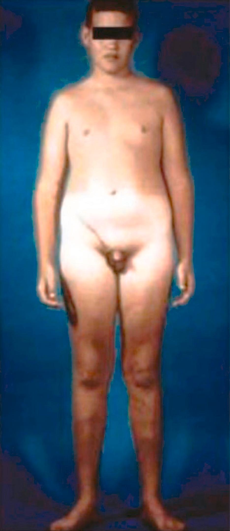 Fig. 8.13, A male with 47, XXY Klinefelter syndrome.