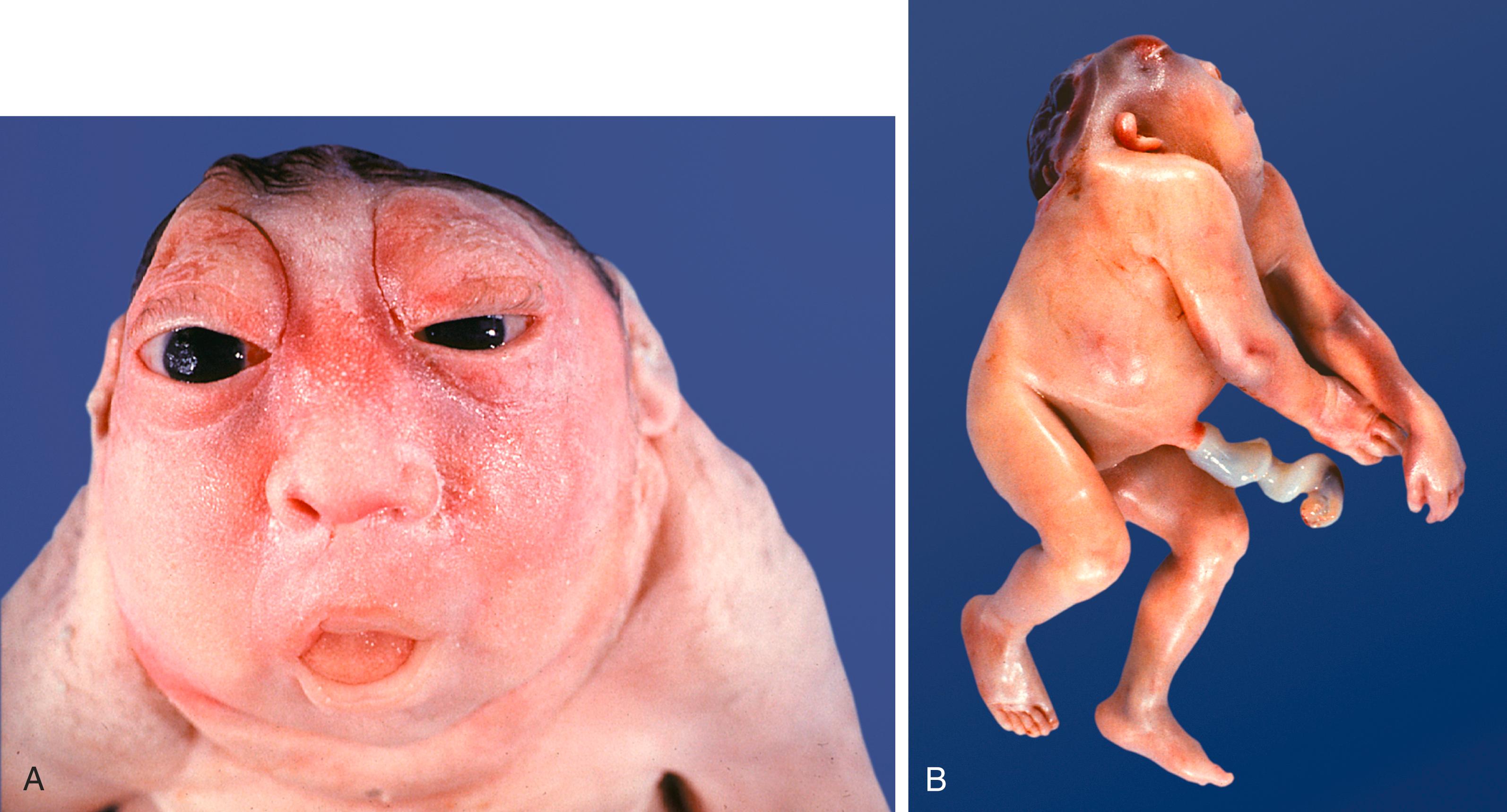 Fig. 8.5, Frontal (A) and lateral (B) views of anencephaly.