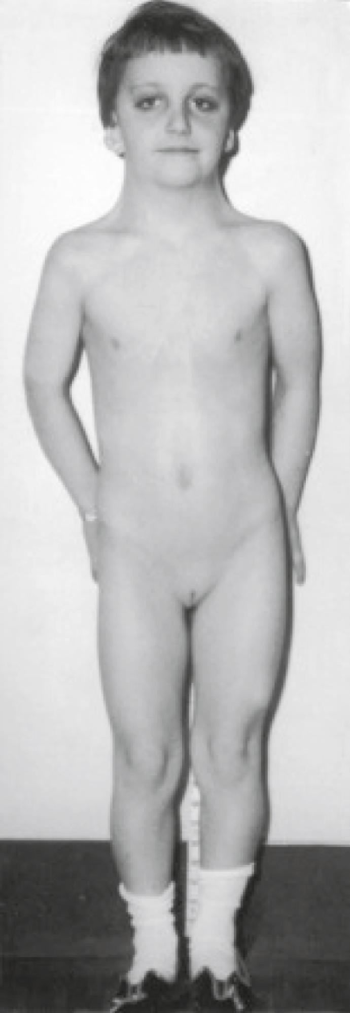 Fig. 8.10, A 13-year-old girl with 45 XO Turner’s syndrome. Note the webbed neck, short stature, and infantile sexual characteristics. She also had coarctation of the aorta (see p. 460).