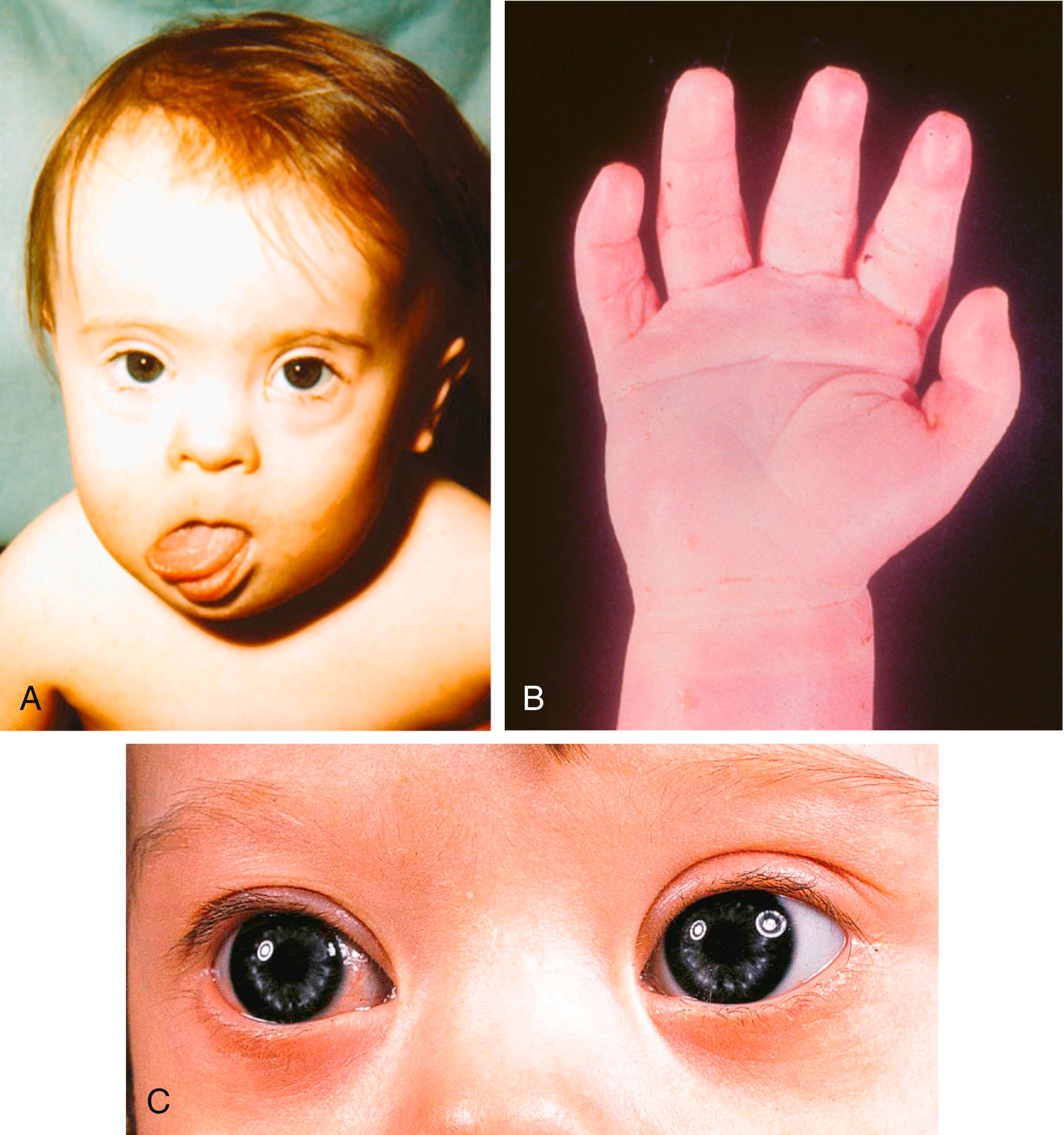 Fig. 8.11, (A) Face of a child with Down syndrome. Note the flat profile, protruding tongue, saddle-shaped bridge of nose, and low-set ears. (B) Hand of an infant with Down syndrome shows the prominent simian crease that crosses the entire palm. (C) Close-up view of the midface of a child with Down syndrome. Note the ring of light Brushfield spots in the eyes, the nasal bridge and the bilateral epicanthic folds.