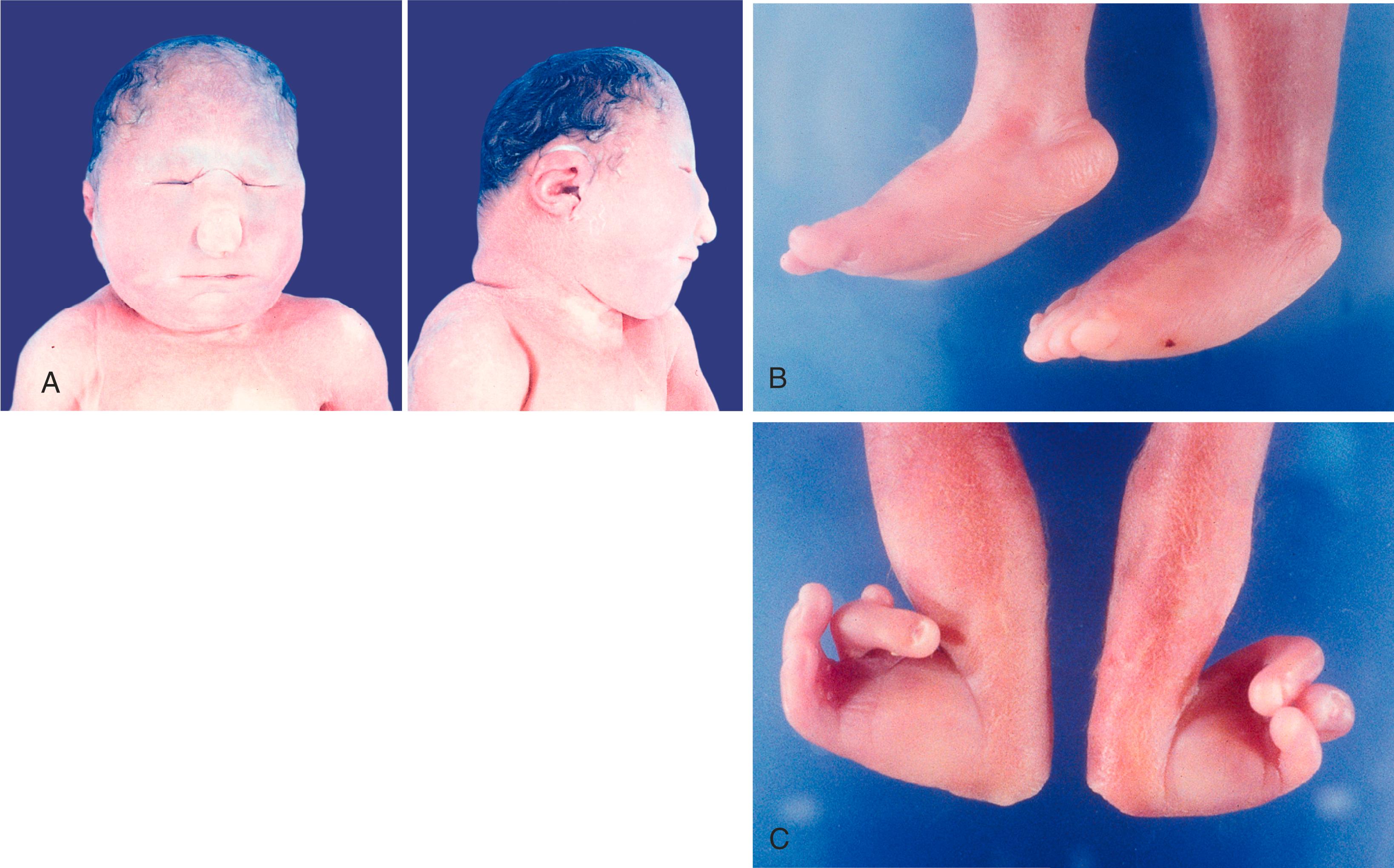 Fig. 8.12, (A) Front and lateral views of the head of a 34-week fetus with trisomy 13. This fetus shows pronounced cebocephaly with a keel-shaped head, a flattened nose, abnormal ears, and a reduction of forebrain and upper facial structures. (B) Rocker-bottom feet from a fetus with trisomy 18. Note the prominent heels and convex profile of the soles of the feet. (C) Pronounced radial deviation of hands (club hands) of the same infant as in (B).