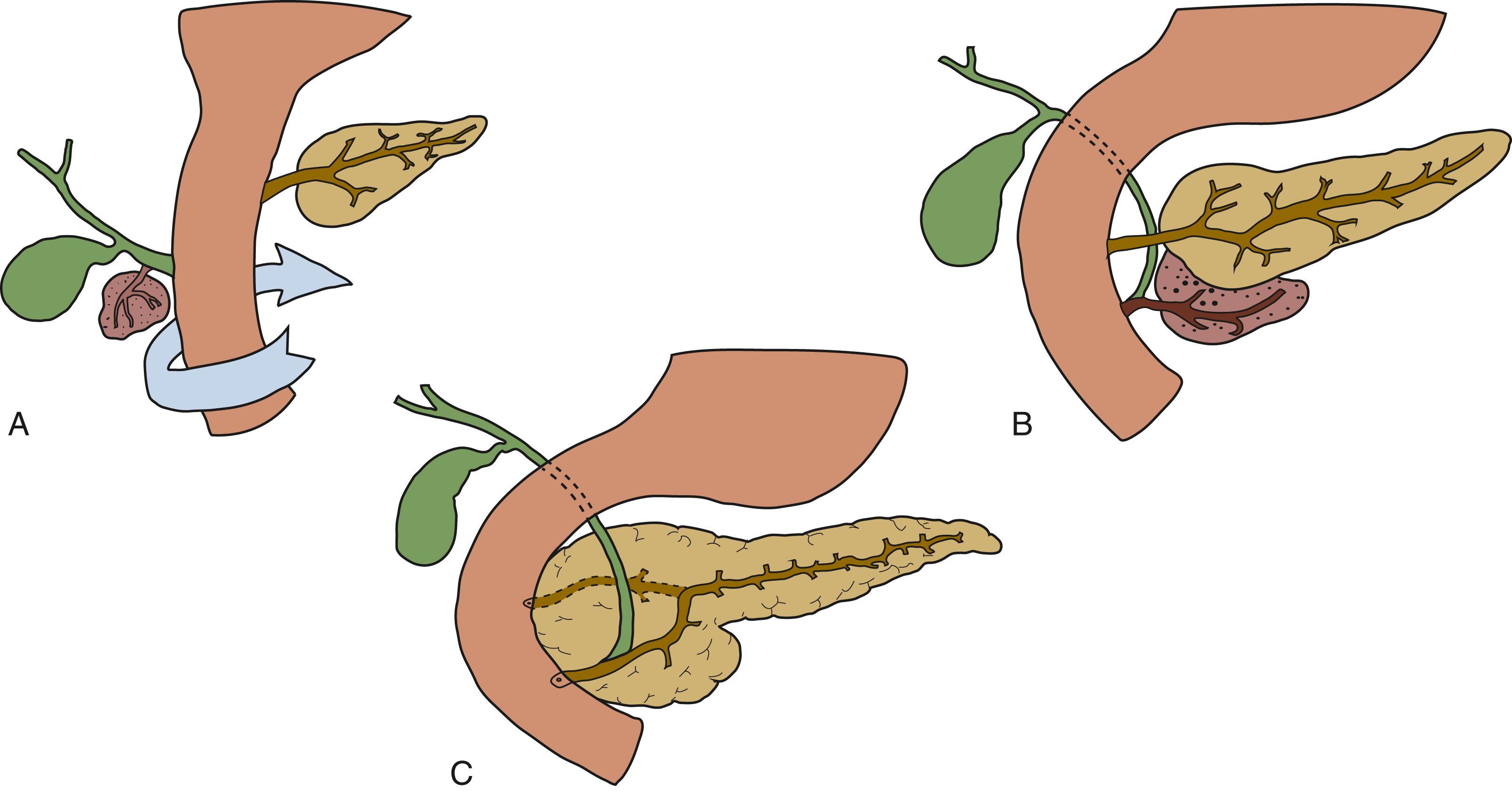 FIGURE 37.1, Embryology of the pancreas.