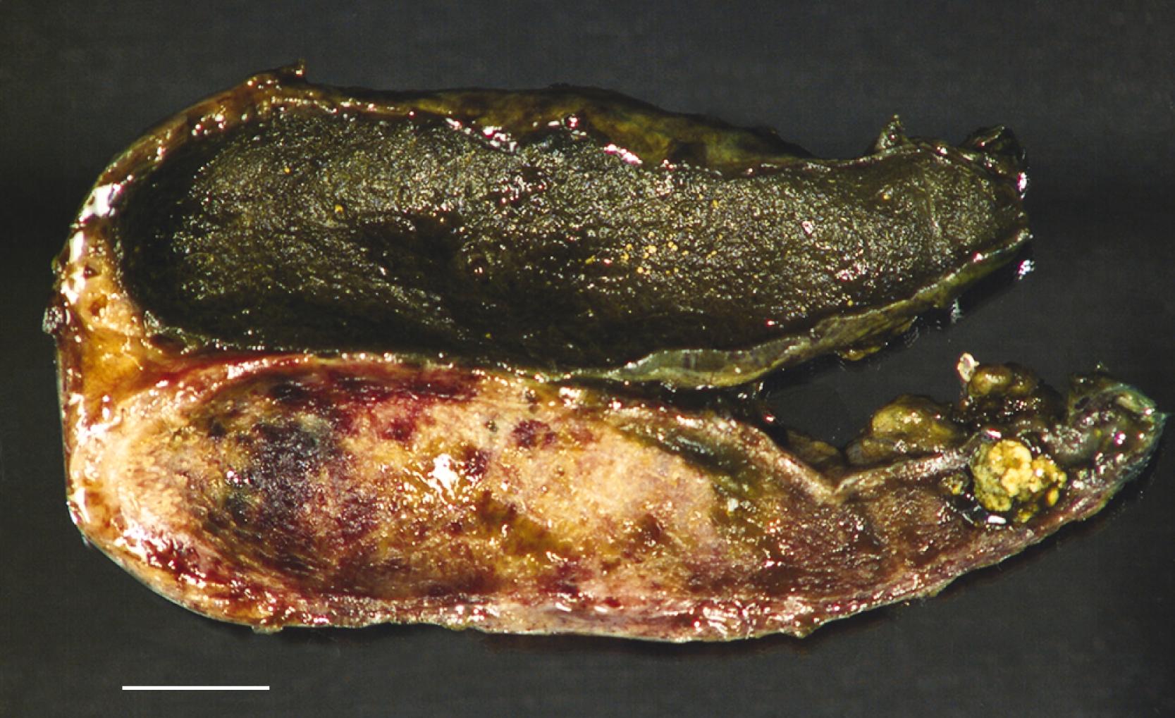 FIGURE 37.2, Duplicated gallbladders.