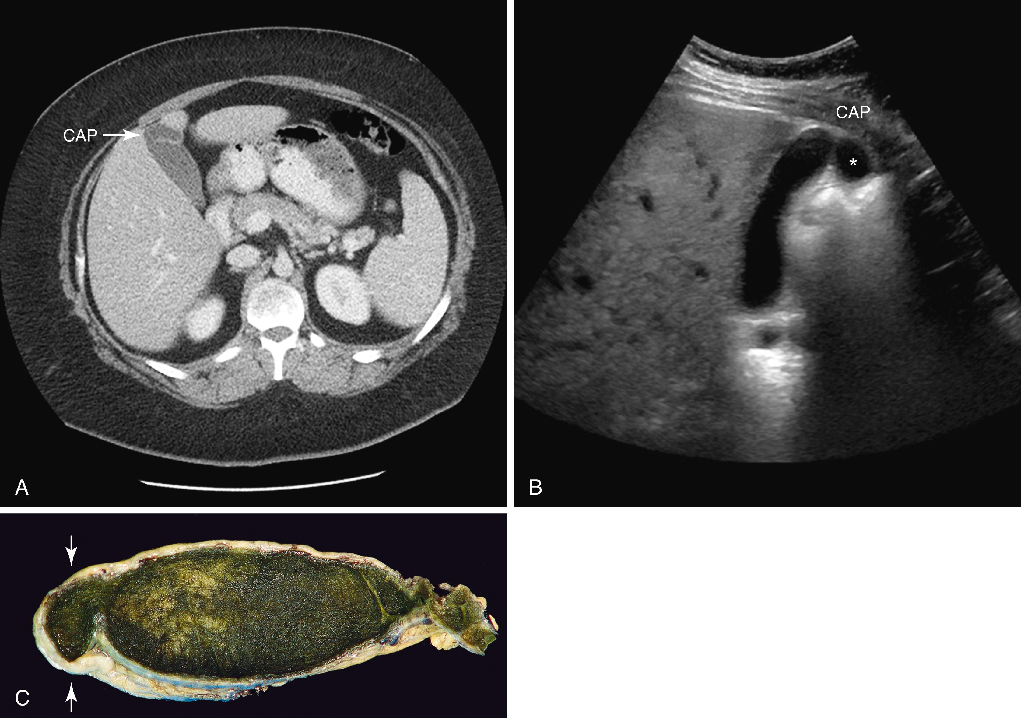 FIGURE 37.4, A , Appearance of the Phrygian cap ( CAP ) of the gallbladder on abdominal computed tomography. B , Appearance of the CAP (asterisk) on ultrasonography. C, Photograph of a resected gallbladder with a CAP (arrows) .