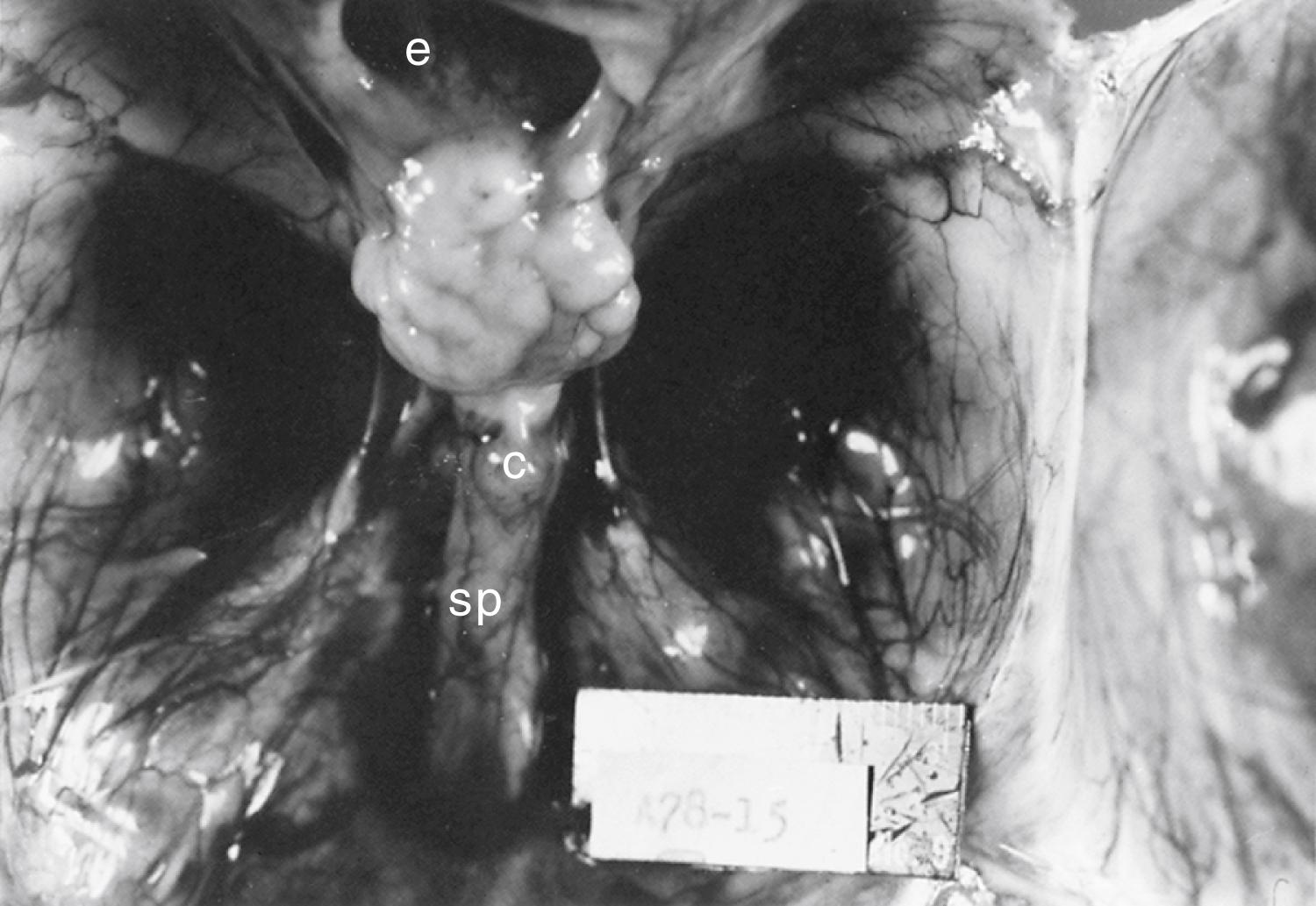 Fig. 89.1, Severe Cerebral Hypoplasia.