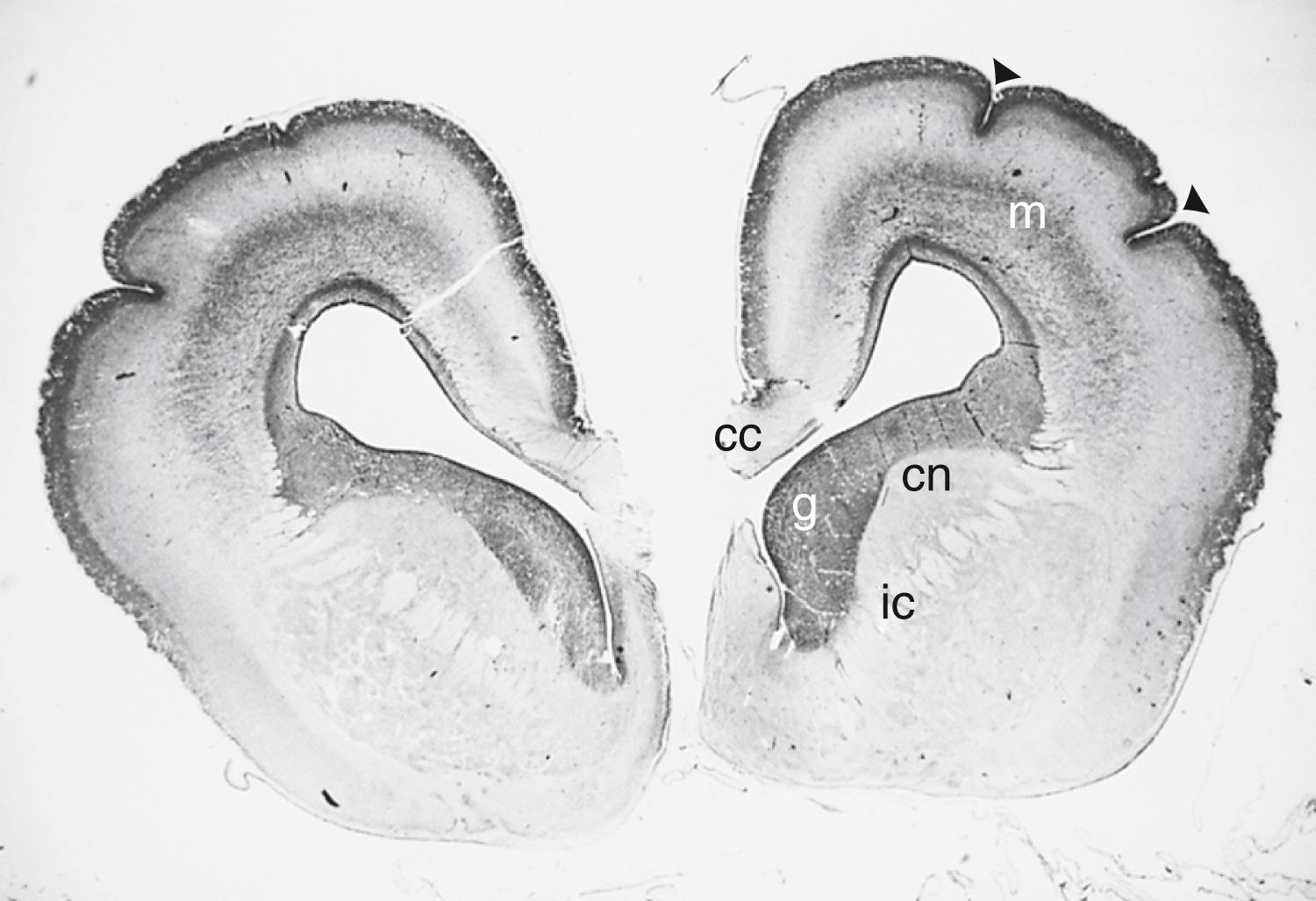 Fig. 89.2, Coronal section of forebrain of 16-week normal fetus, showing extensive subependymal germinal matrix (g) of neuroblasts and glial precursors that have not yet migrated. The surface of the brain is just beginning to develop sulci (arrowheads) . Migrating neuroblasts (m) are seen in the subcortical white matter. The corpus callosum (cc) is artifactually ruptured, and the two hemispheres should be closely approximated. (Hematoxylin-eosin stain.) cn , Caudate nucleus; ic , anterior limb of internal capsule.