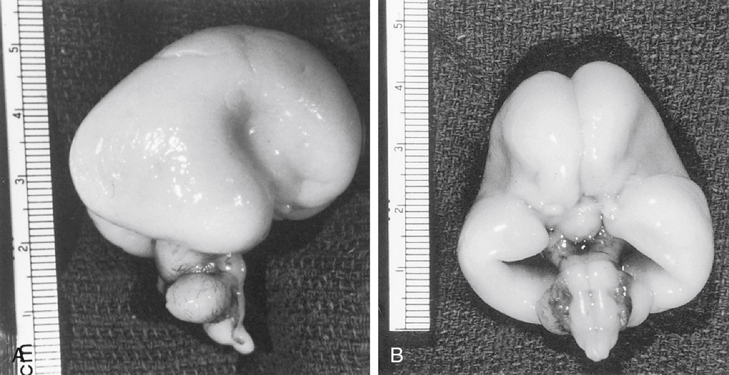 Fig. 89.3, Lateral ( A ) and ventral ( B ) views of a normal brain of a 16-week fetus. Primary fissures (e.g., sylvian, calcarine) are formed early in gestation, but primary sulci, such as the central and parieto-occipital, form at midgestation, and secondary and tertiary sulci and gyri develop after 22 weeks. At midgestation the surface of the cortex is essentially smooth.