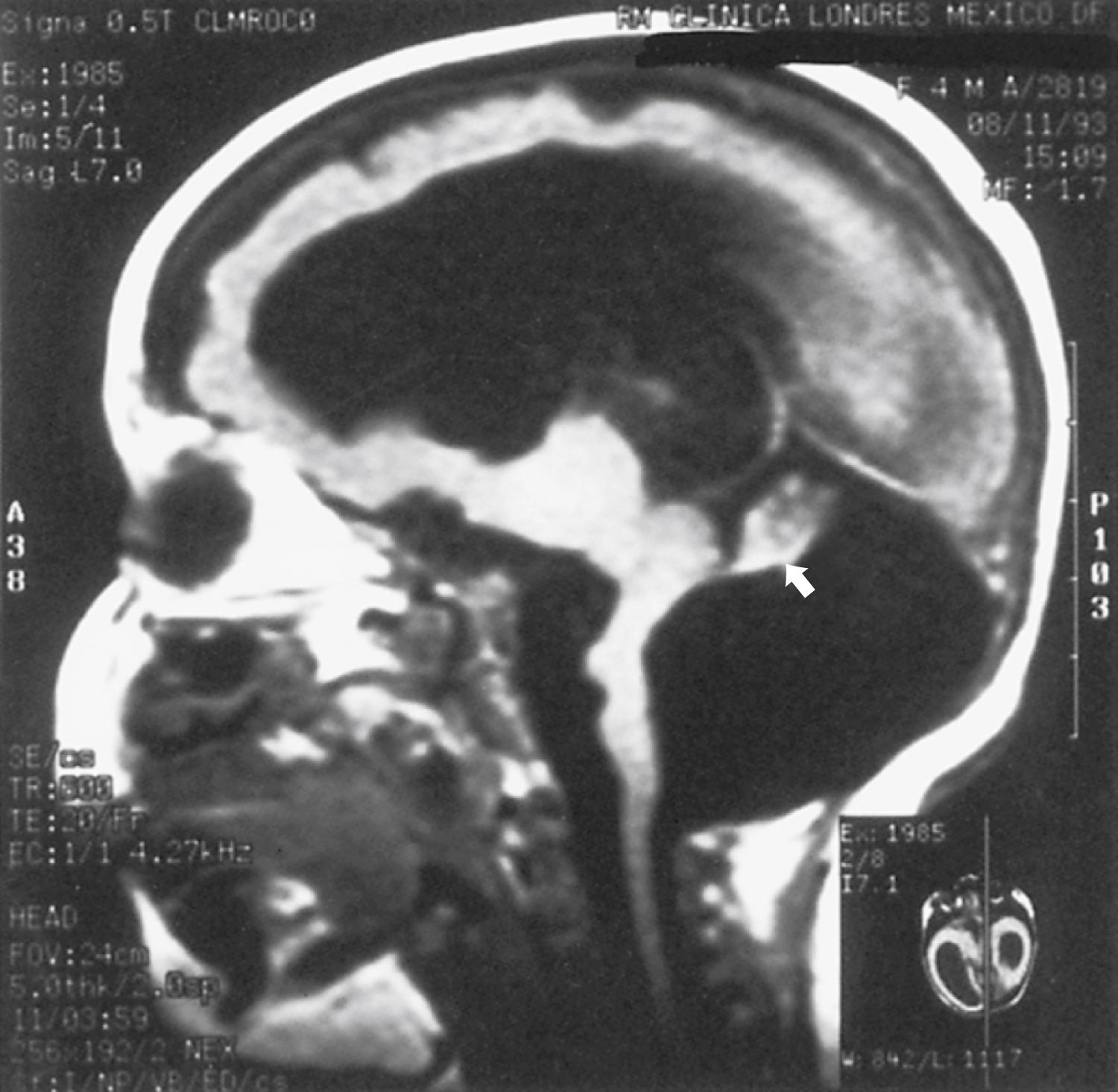 Fig. 89.5, Sagittal T1-weighted magnetic resonance image of a 10-month-old girl with lissencephaly type 2 and Dandy-Walker malformation. The cerebral mantle is thin, and the lateral ventricles are greatly enlarged. A few abnormal shallow fissures at the cerebral surface may indicate abortive gyration or pachygyria. The cerebellum is severely hypoplastic ( arrow indicates anterior vermis), and the posterior fossa contains a large fluid-filled cyst. The brainstem also is hypoplastic, and the basis pontis is nearly absent. A differential diagnosis of this image is pontocerebellar hypoplasia, but the high position of the torcula indicates a Dandy-Walker malformation.