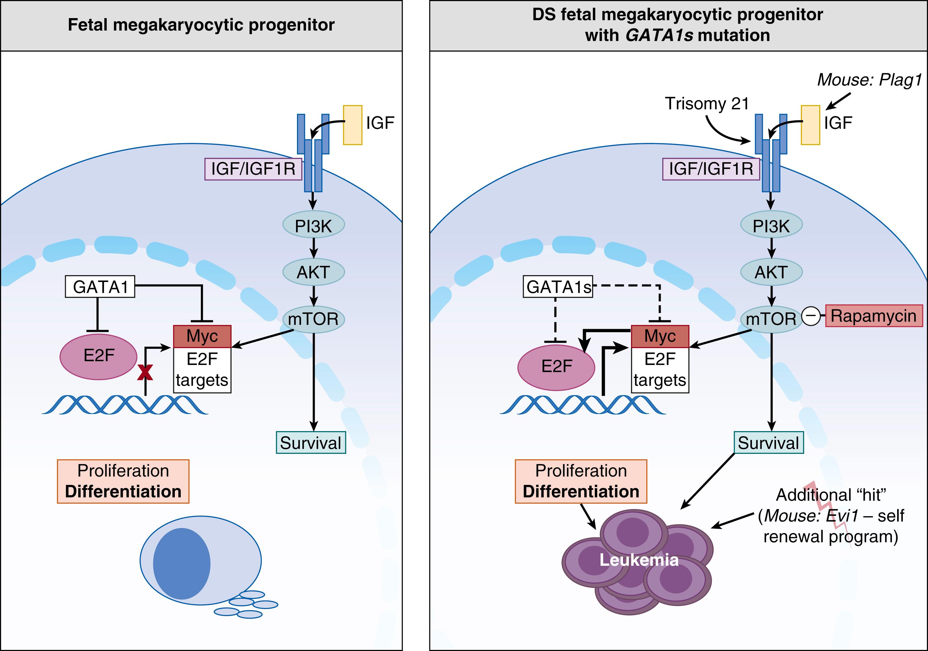 Fig. 110.5, GATA1 full-length protein restricts insulin-like growth factor (IGF) signaling-induced proliferation of fetal megakaryocytic progenitors. Full-length GATA1 represses E2F activity, coordinating terminal megakaryocytic differentiation and proliferation of IGF1/IGF1R signaling-dependent fetal progenitors. GATA1s fails to repress E2F activity, leading to their uncontrolled proliferation and increased survival.