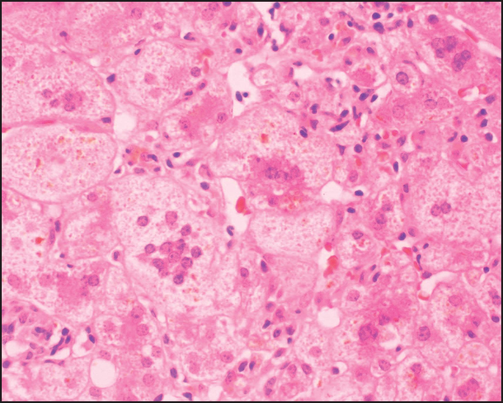 Figure 3.1, Neonatal hepatitis, idiopathic, with giant cell transformation. (Haematoxylin and eosin [H&E] stain.)